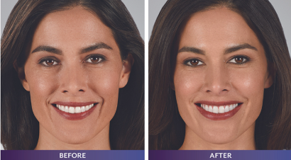 Natural-Looking Results With Juvederm Fillers at Banff Aesthetics