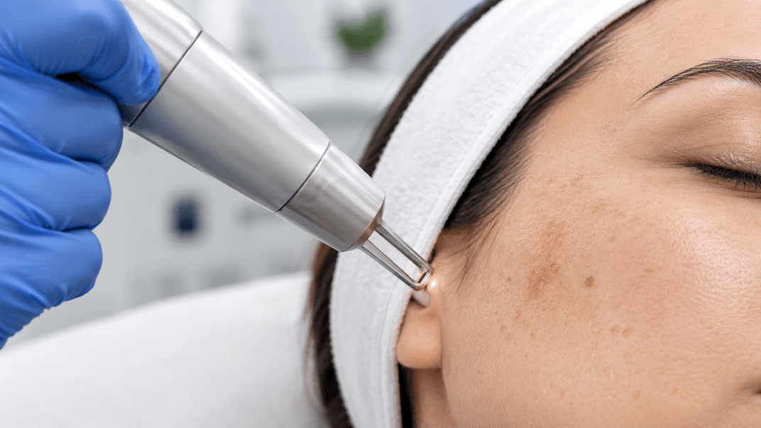 Picosecond Laser - Pigmentation