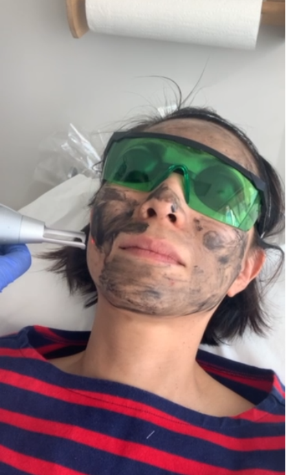 Hollywood Peel for skin rejuvenation Toronto
