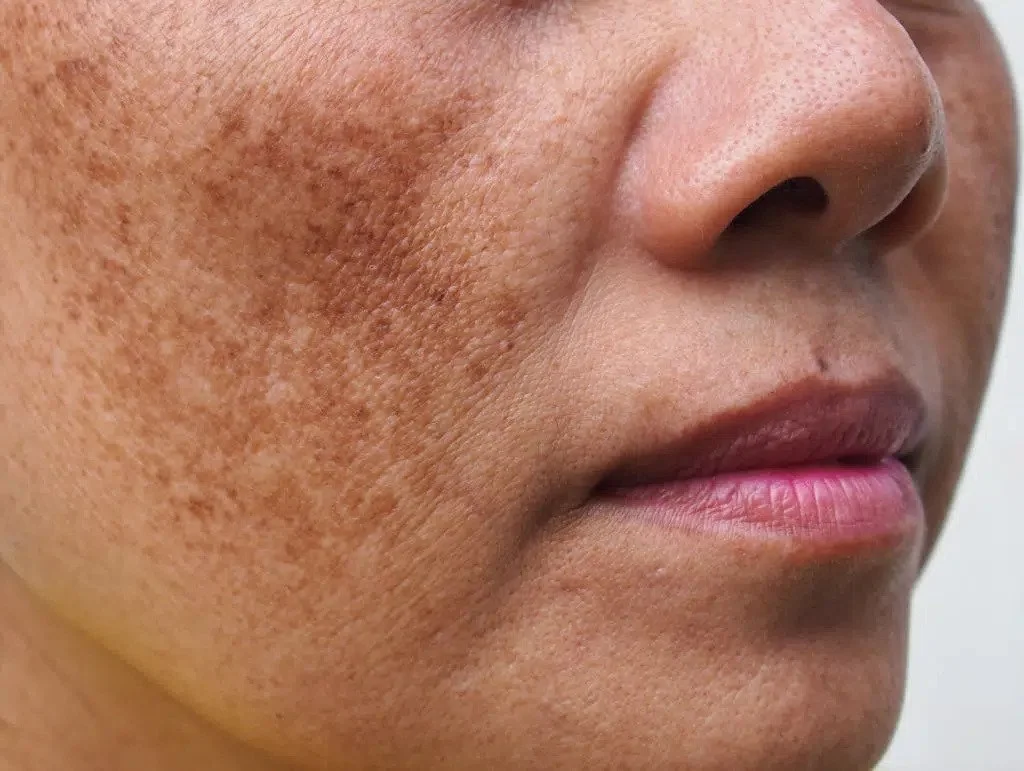 Woman with hyperpigmented skin