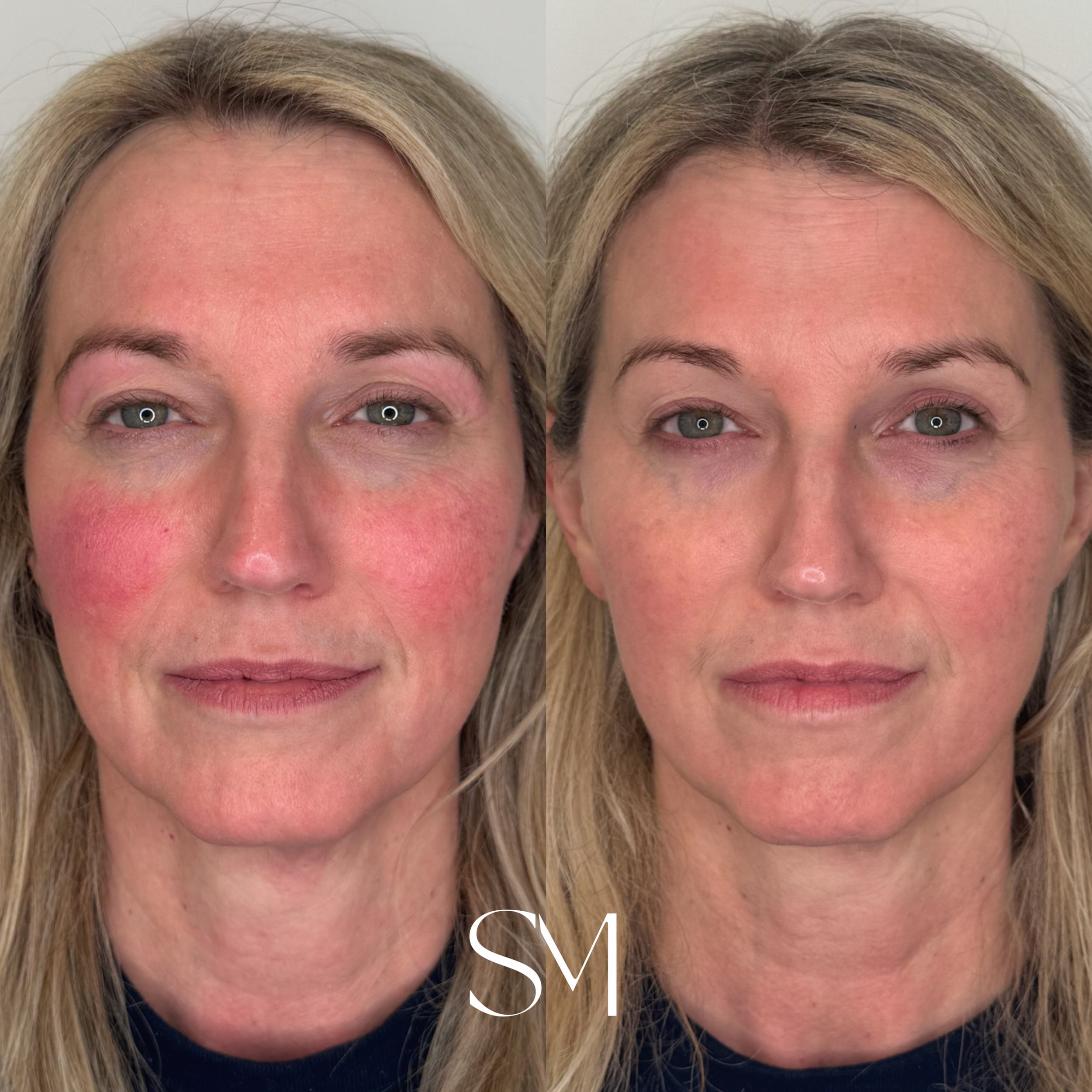 Alpha IPL - One Treatment