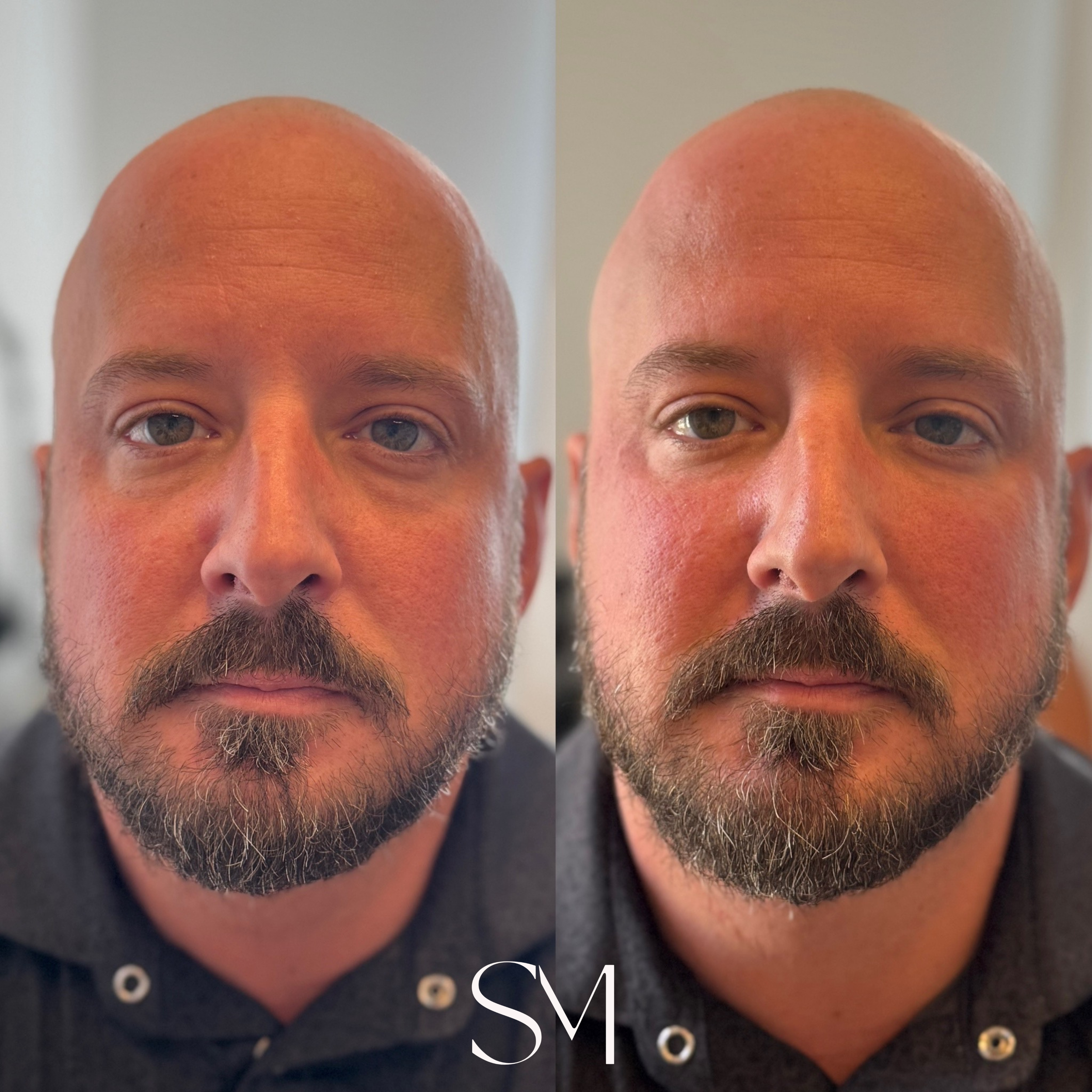 Full Face Derma PRP