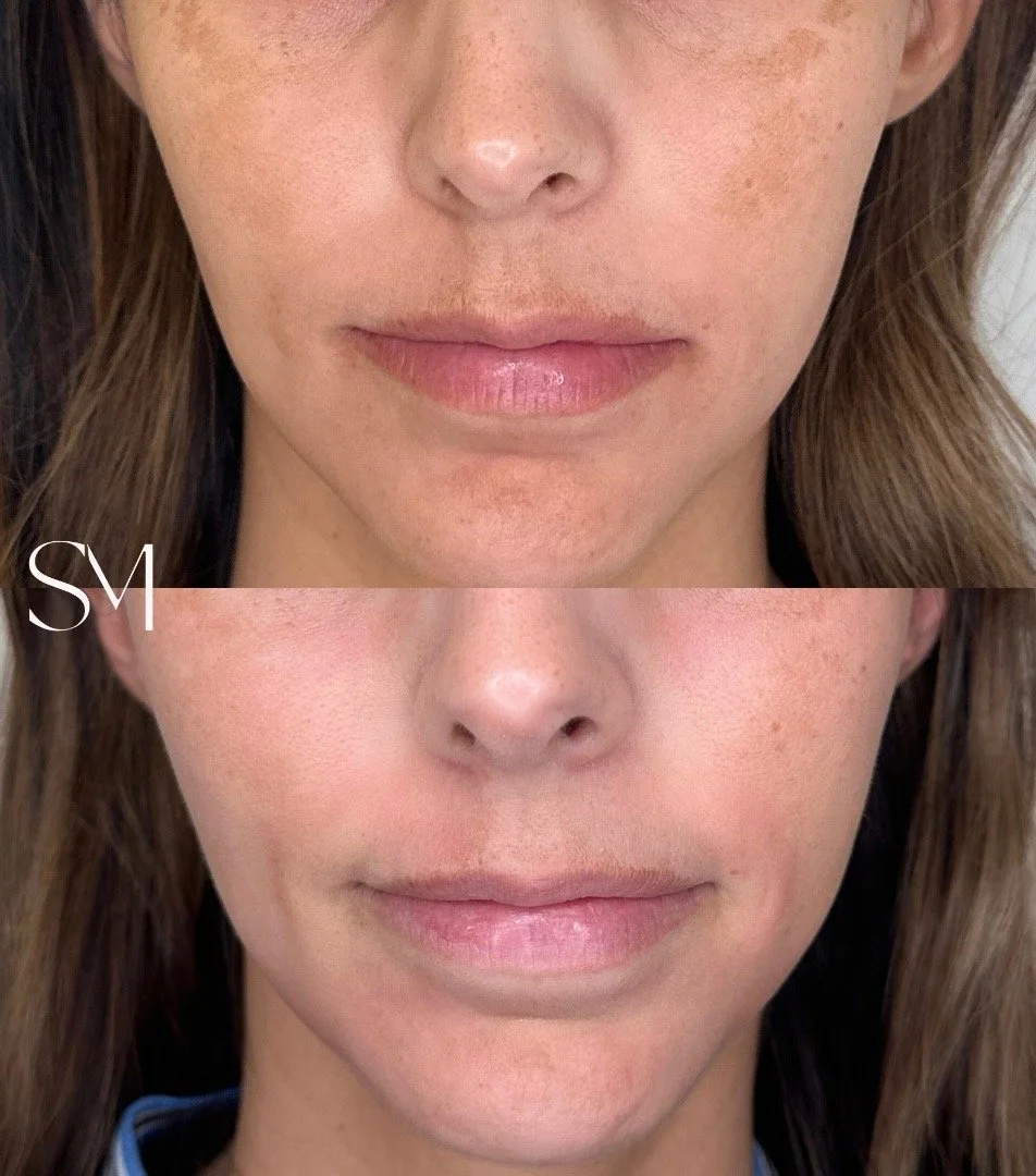 NouvaDerm for Melasma