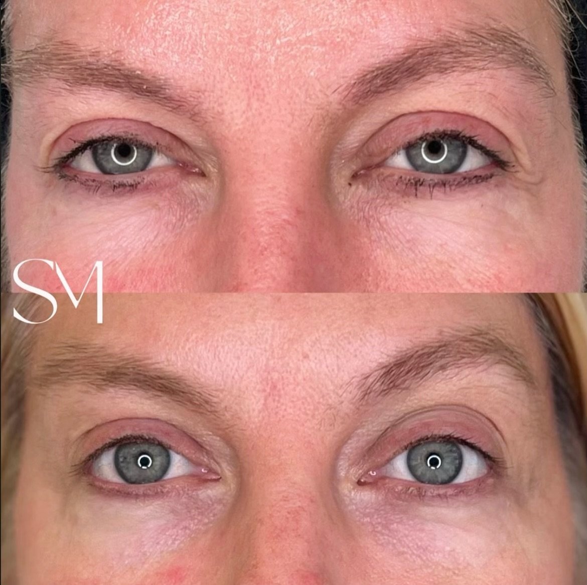 Look at the ✨DIFFERENCE✨after only T W O Tixel treatments! We are obsessed with the results we are seeing with our tightening and resurfacing device!! 

Click the link in my bio to book! 🔗🤍
