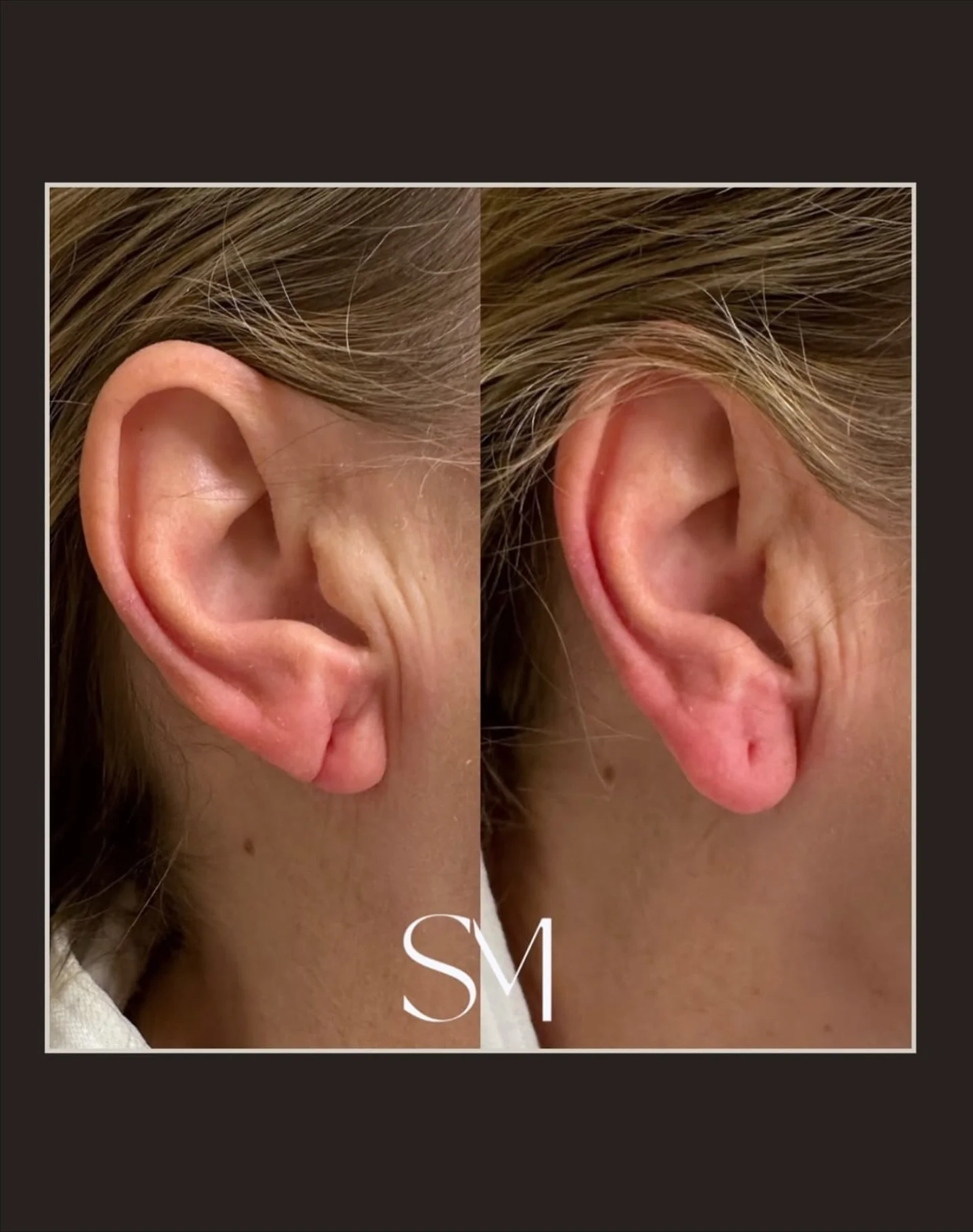 Did you know we can treat sagging or damaged ear lobes with filler? You don&rsquo;t really appreciate ear lobe rejuvenation until you can wear your favorite pair of earrings again🤩👏🏼 Click the link in our bio to book your appointment at either of 