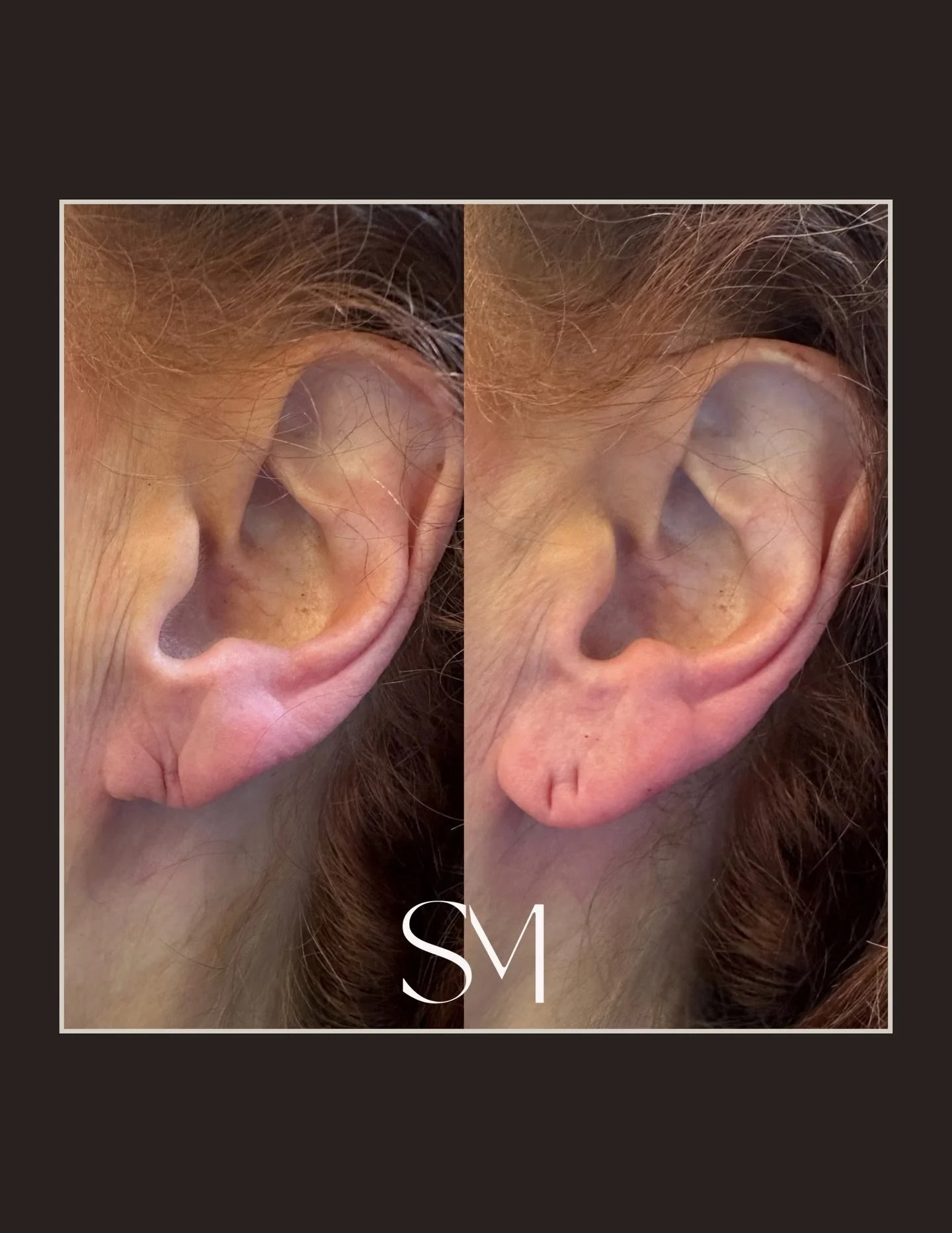 One of aesthetics&rsquo; best kept secrets

Earlobe filler restores volume, smooths creasing, and corrects stretched lobes in minutes👏🏼 A delicate correction that makes everything✨