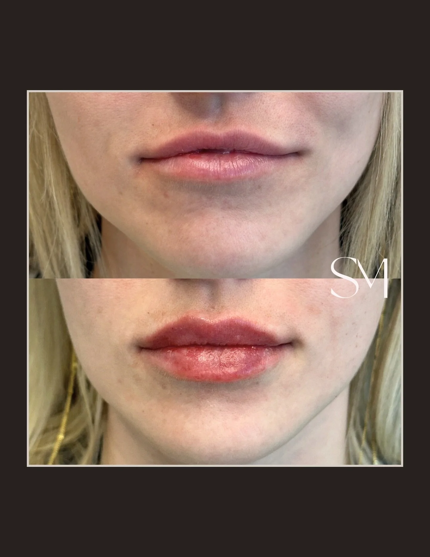 Volume where it matters. Structure where it&rsquo;s needed. 👏🏼💋
Nothing overdone, just thoughtfully enhanced to balance the lower face and restore hydration and definition. 

Book your consultation using the link in our bio✨