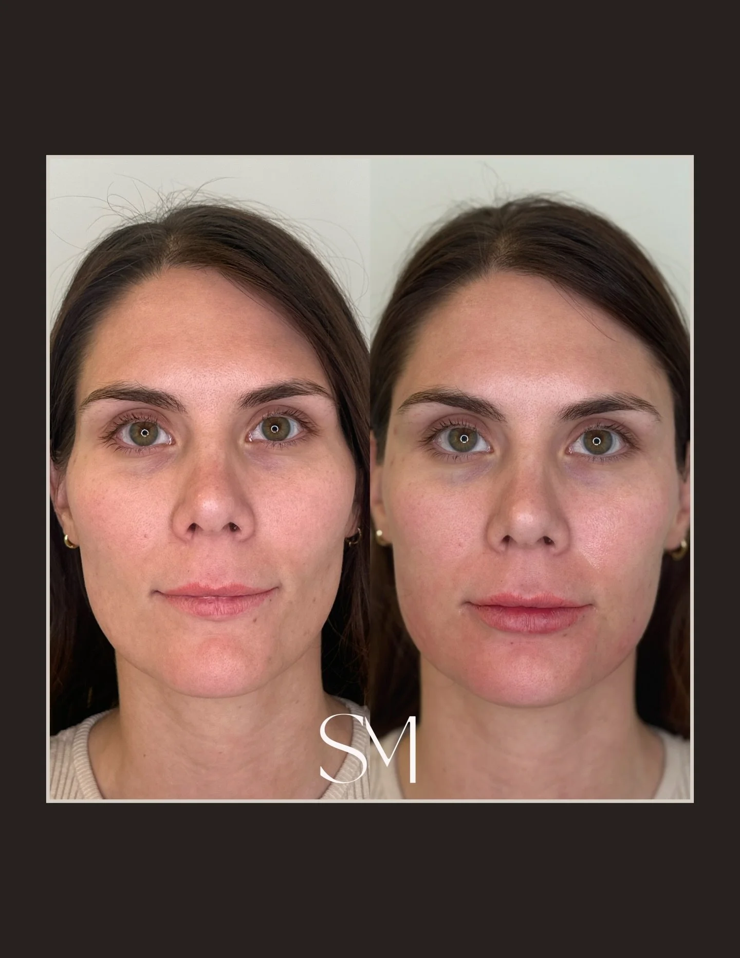 Full face harmonization👏🏼 subtle shifts, powerful transformation. ⬇️

💉Temple correction with filler + Sculptra
💉Cheek enhancement with Sculptra
💉Chin shadow + pre-jowl sulcus refined with filler
💉Mini lip refresh

Book your consultation to exp