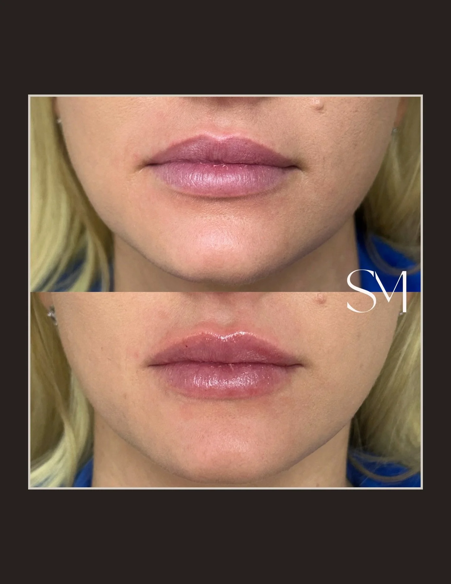 Soft maintenance, subtle impact. 💋 Half a syringe to restore shape, refine symmetry, and keep everything looking effortlessly balanced.

📲Reserve your refresh today.