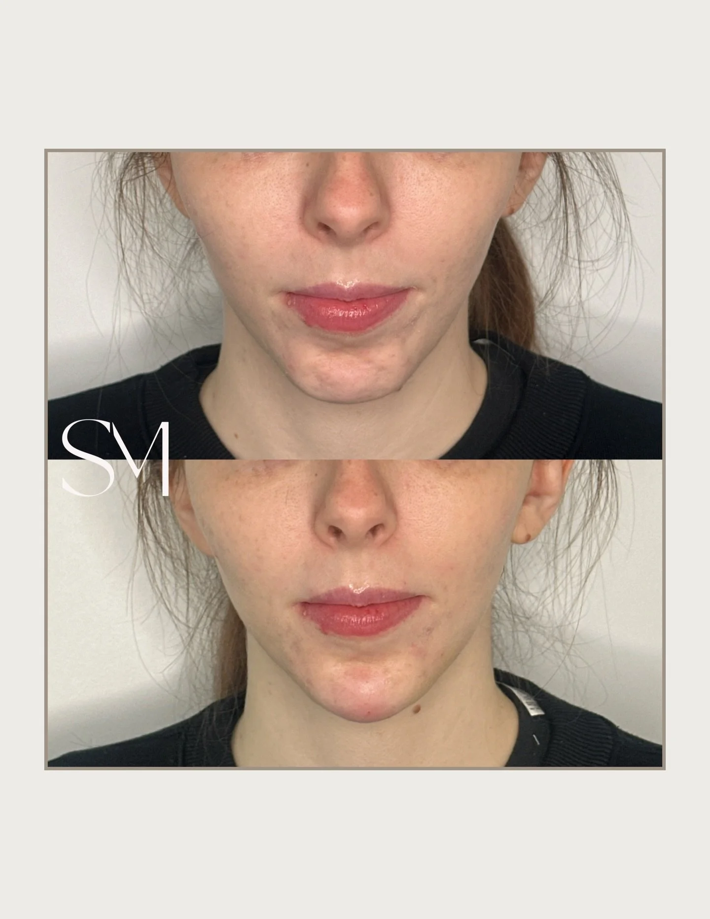 Some lower facial balancing for your feed💫 We did two syringes of filler in the chin and pre jowl sulcus + some lower face tox. 💉✨