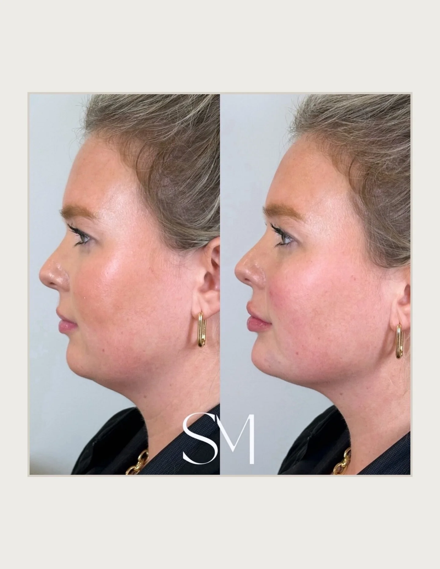 Ever wonder why some results look just right? That&rsquo;s the art of full face rejuvenation 👏🏼 Treating the face as a whole, not in parts. 

Think cheeks, jawline, chin, temples, and under eyes&hellip; working in harmony to enhance your natural be