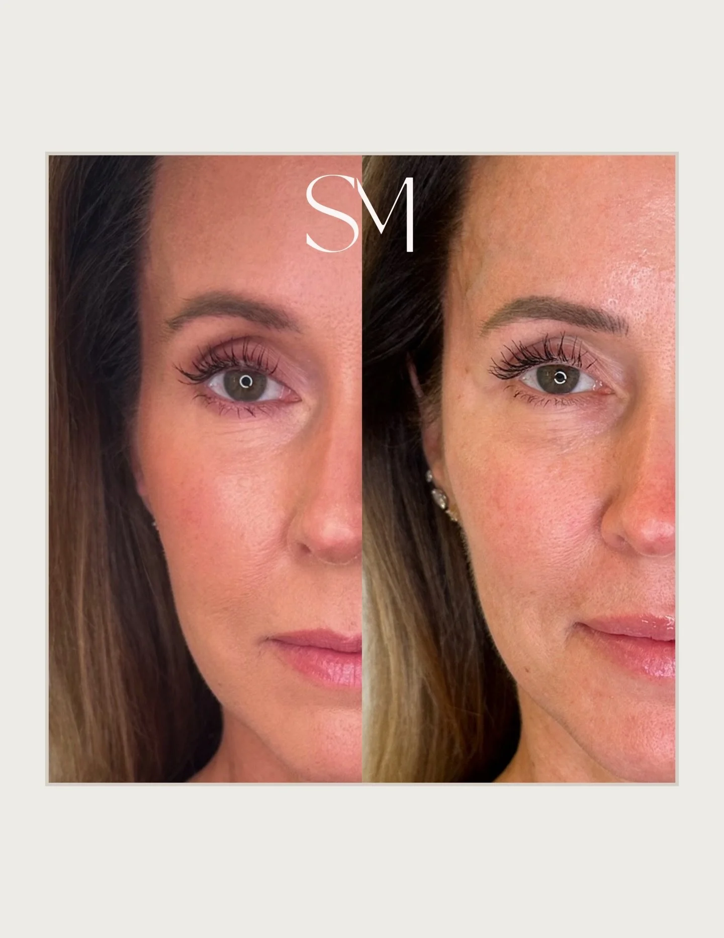 The kind of result you see immediately&hellip; and love even more over time. 👏🏼✨Temple restoration using a strategic combination of hyaluronic acid filler for instant structure and bio-stimulators to support long-term collagen production.

What you