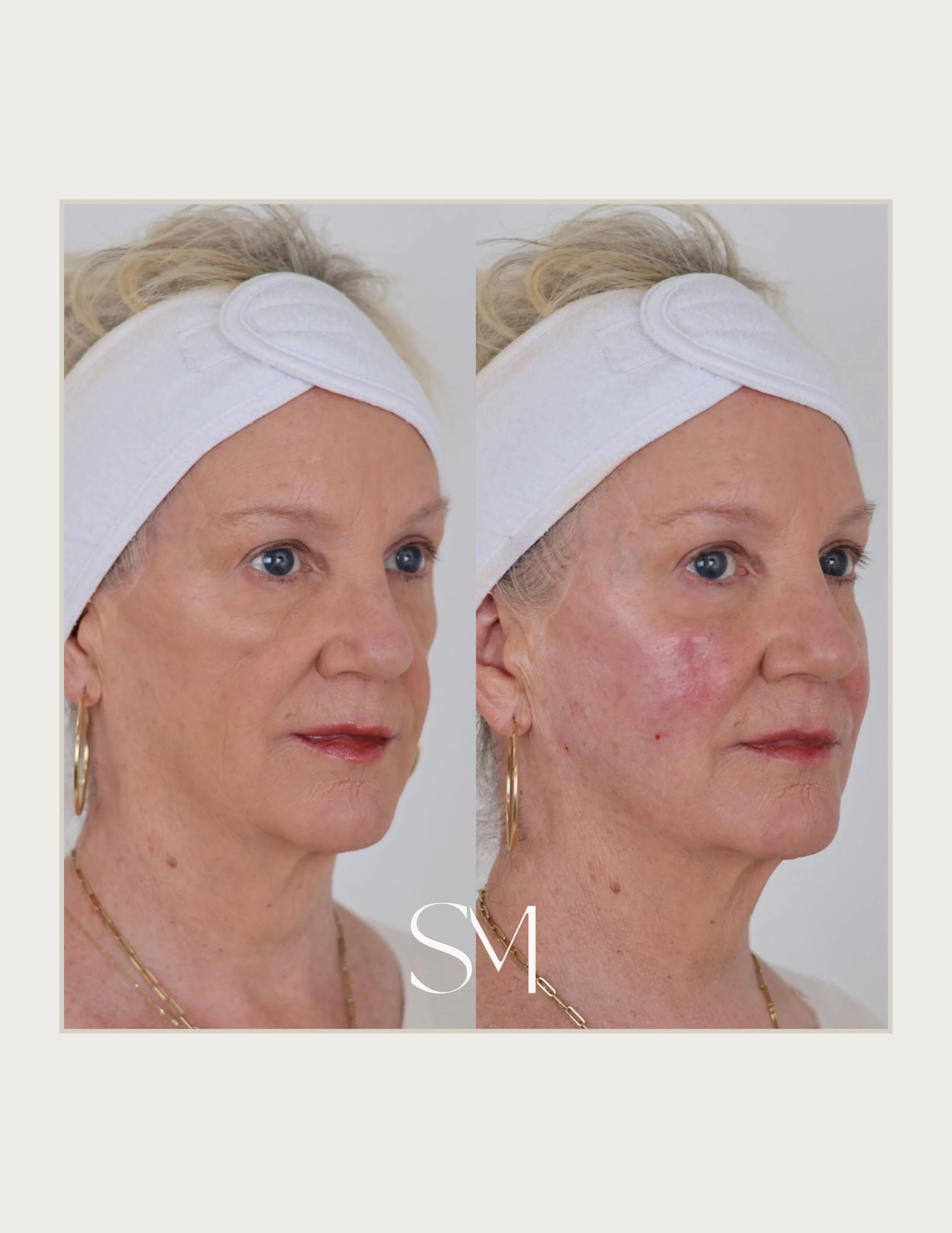 Full face harmony changes everything✨ This full face transformation was achieved through a customized combination of hyaluronic acid filler and Sculptra.💉Pairing instant refinement with long-term collagen stimulation for results that continue to imp