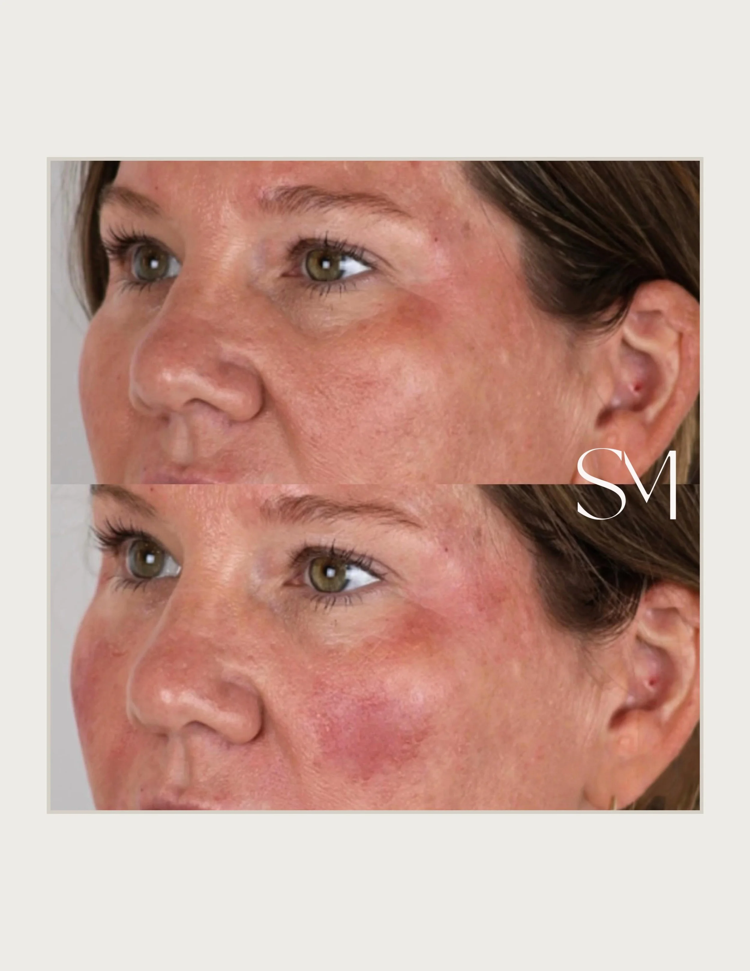 Subtle volume. Softer lines. Brighter under eyes. 👏🏼 Balanced, refreshed, and still completely her. ✨ 

📲Book your consult today using the link in our bio!