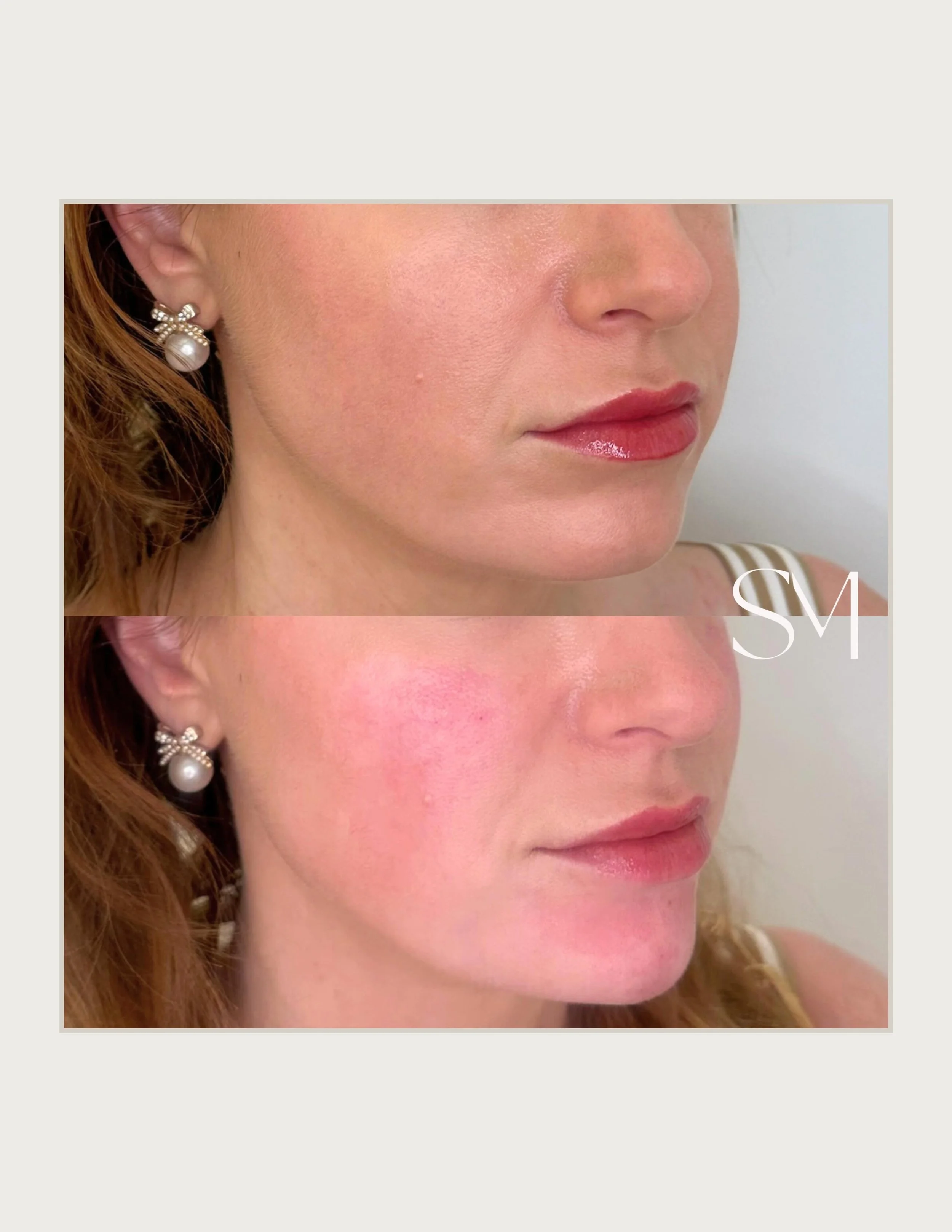 Small changes, big confidence.💫

If you&rsquo;ve been thinking about treatment but want natural-looking results, this is your sign to schedule a consultation. ✨