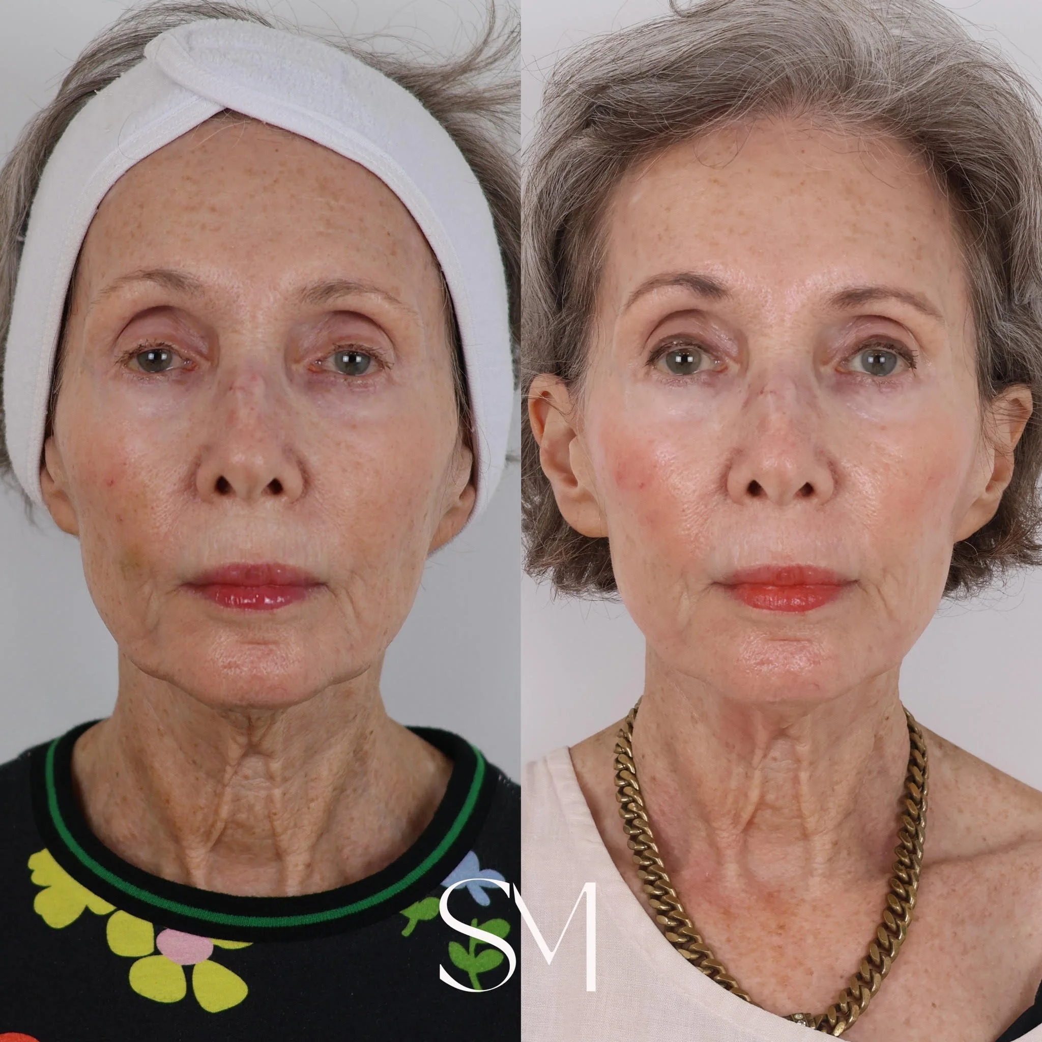 Two PlaDuo Treatments + Sculptra