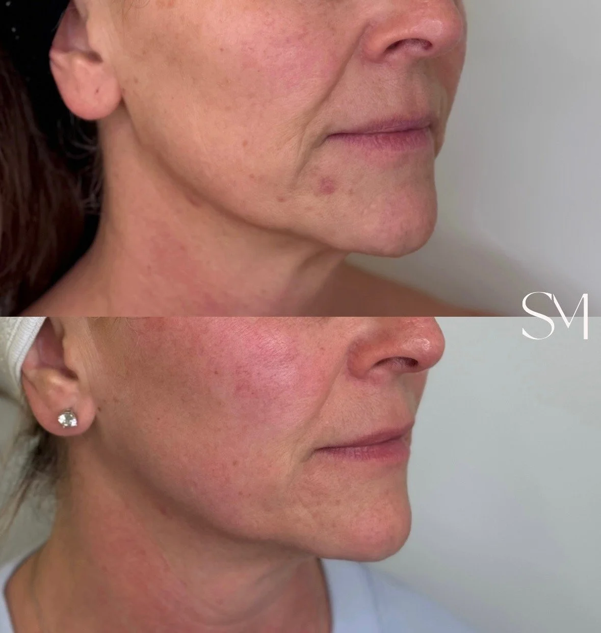 Scarlet RF Face & Neck