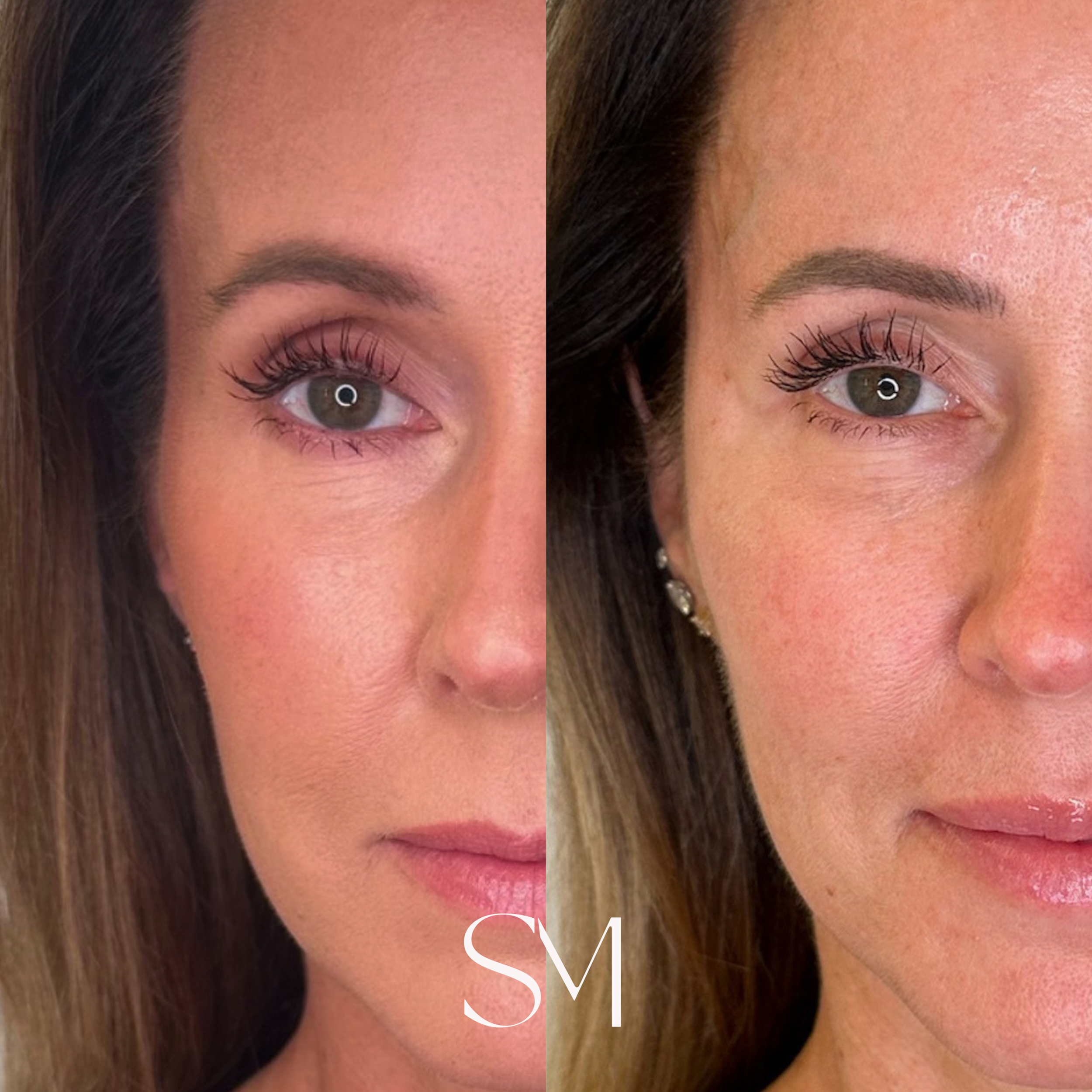 Sculptra + Filler Temples