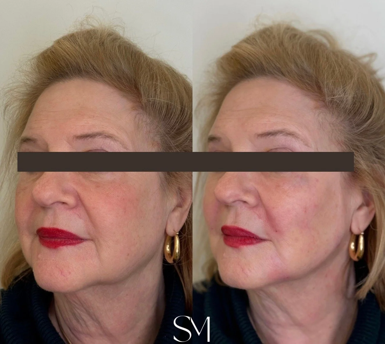 Derma PRP