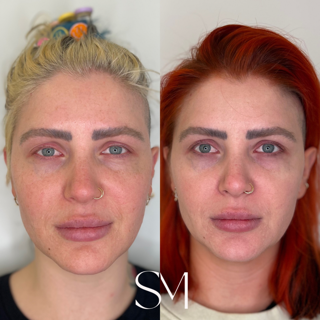 Curated Skincare Routine - 5 SkinPen Treatments + One Chemical Peel
