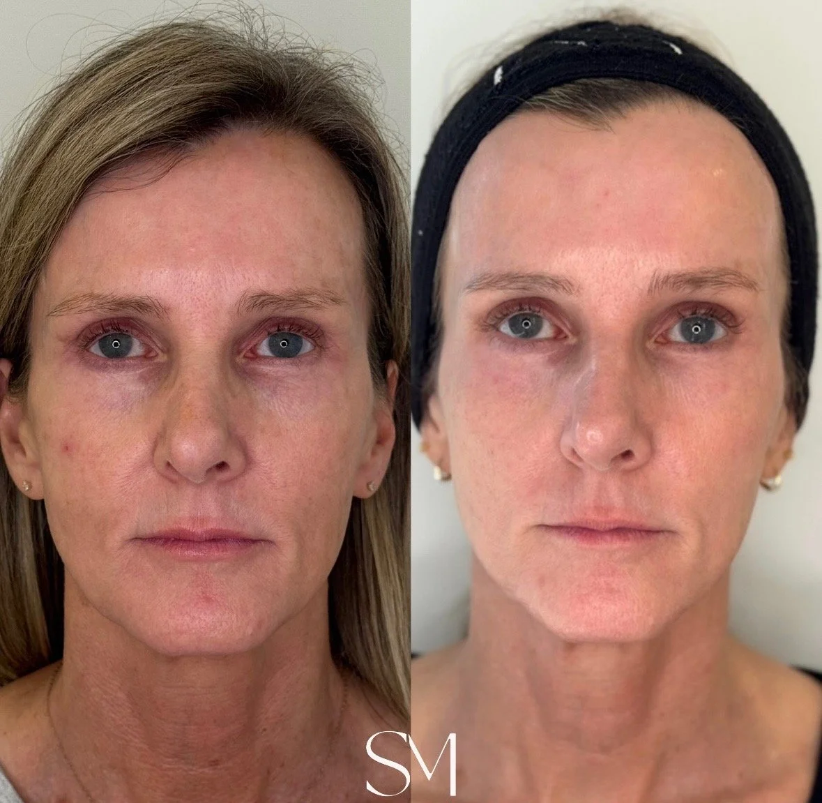 Skin Transformation Membership