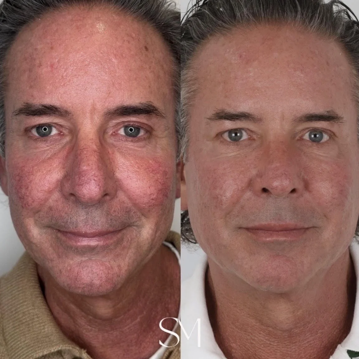 Three Scarlet RF, Three Alpha IPL, One NouvaDerm, One PlaDuo Eye Treatment