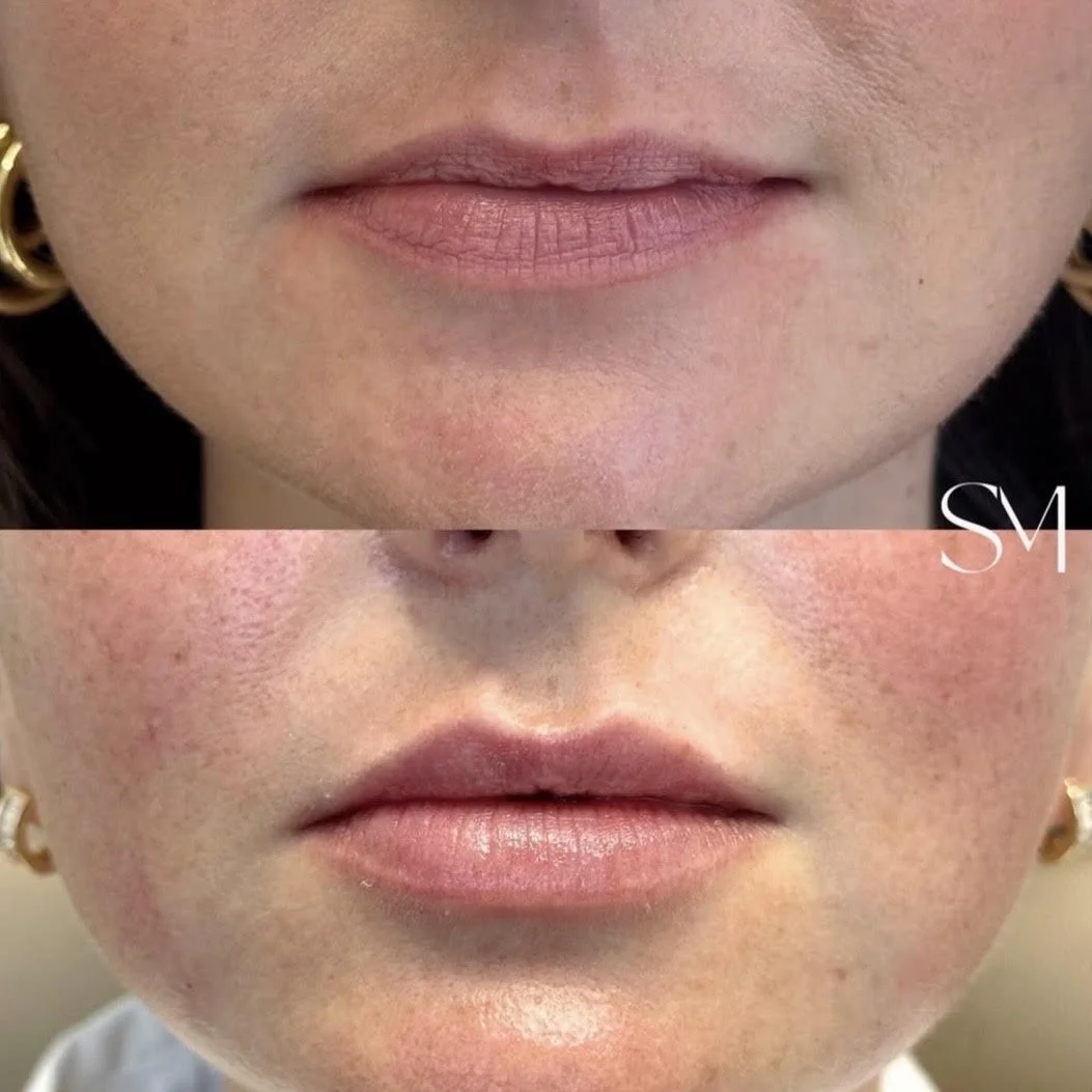 Lip Filler