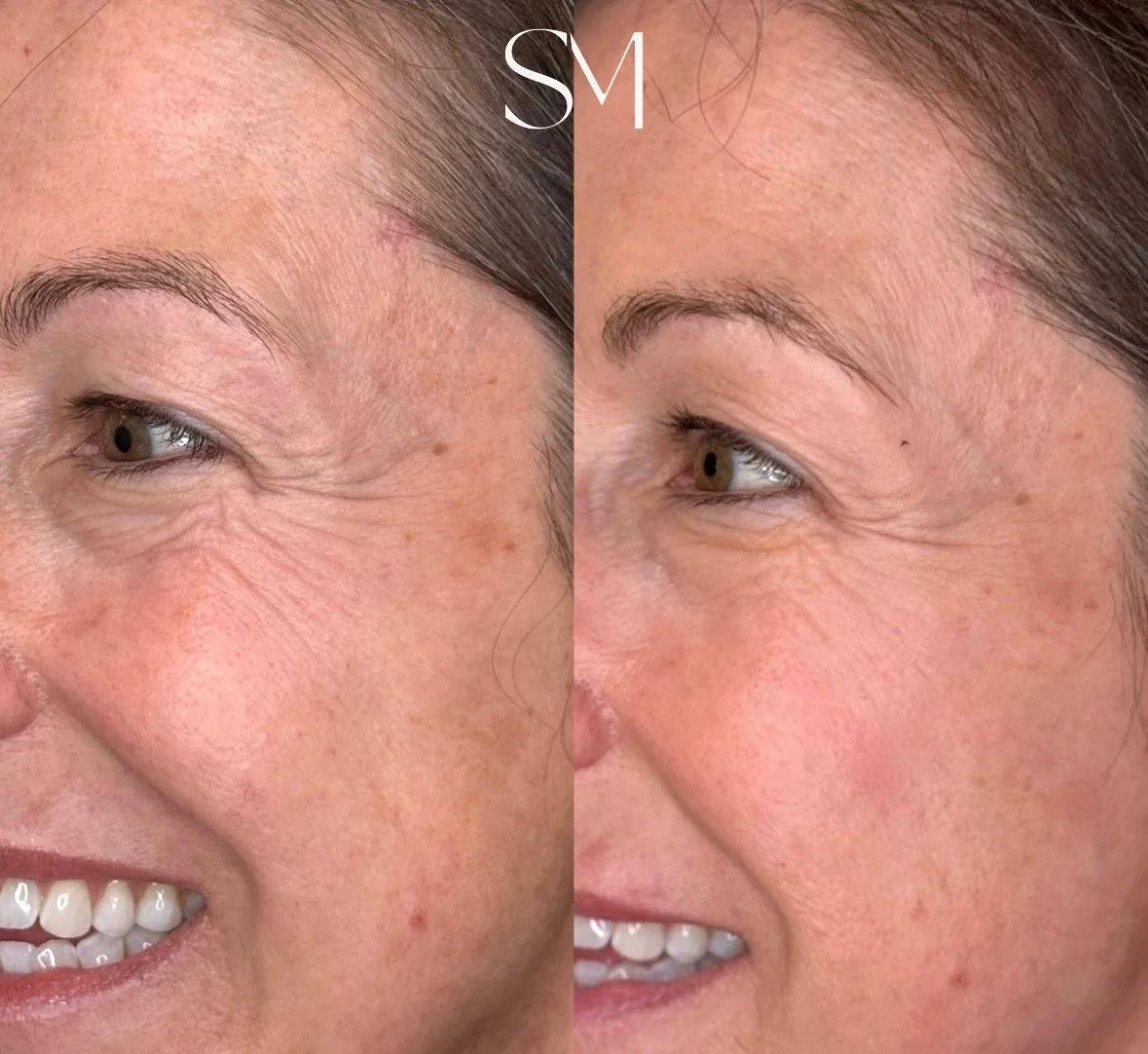 NouvaDerm Treatment *No Tox*