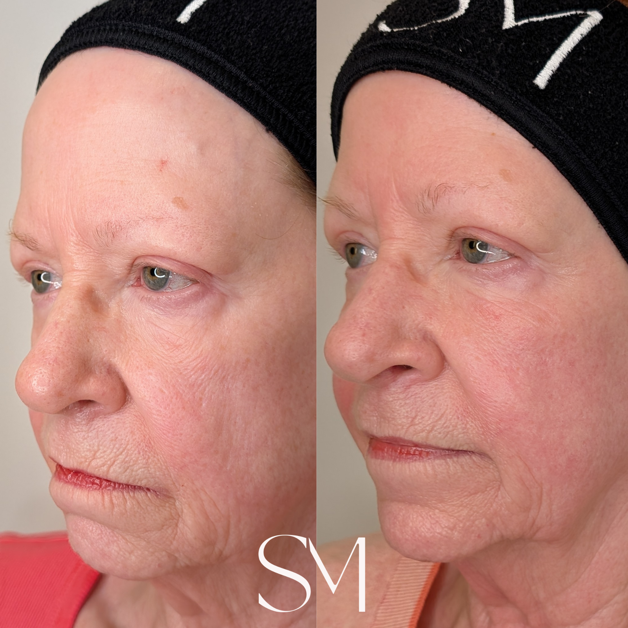 Skin Transformation Membership + One NouvaDerm + One Scarlet RF