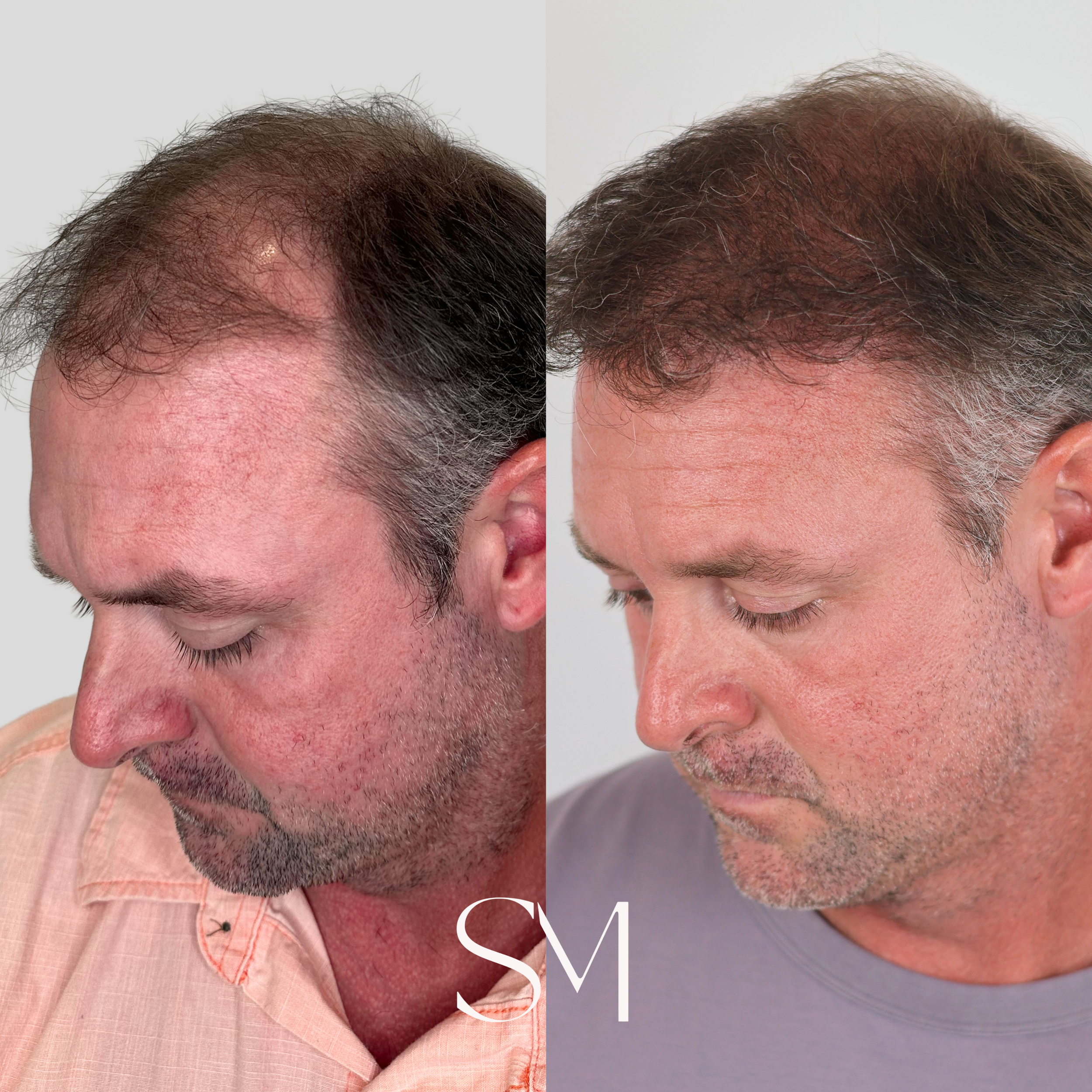 NeoGraft Hair Transplant