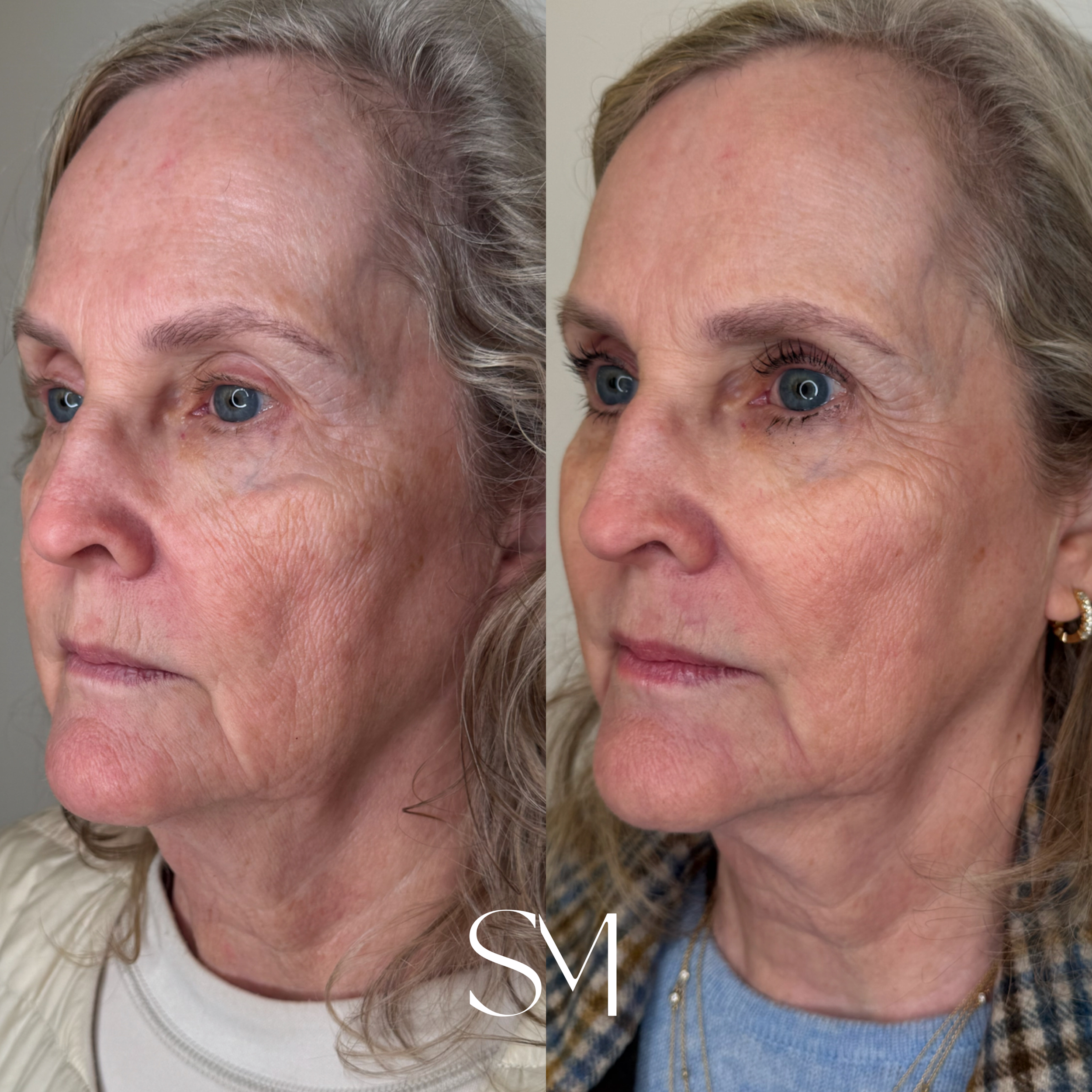 One NouvaDerm Treatment + ZO Peptide *6 Weeks*