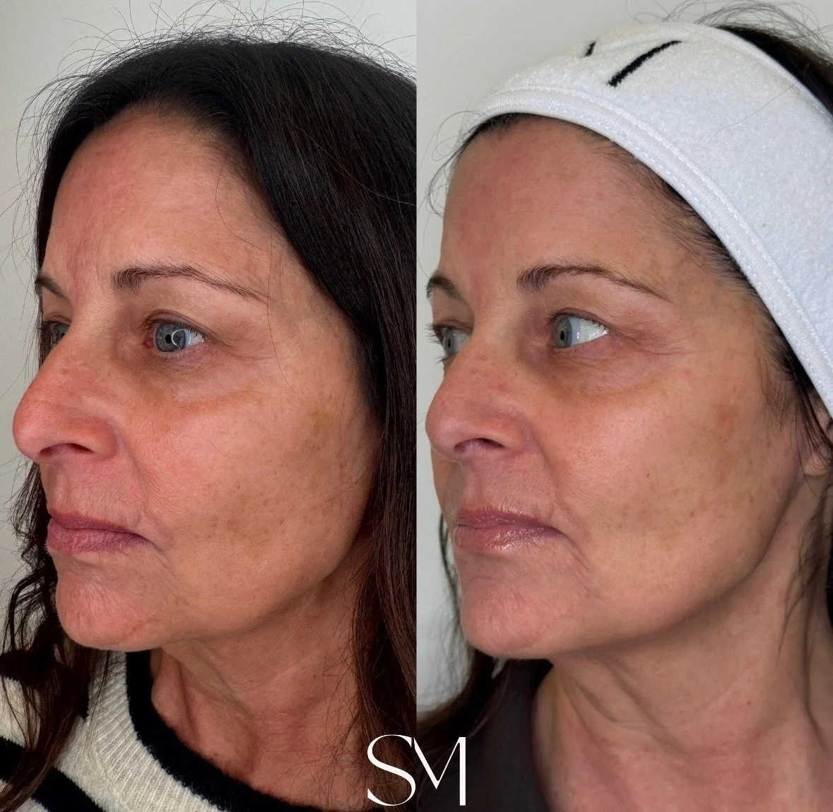 NouvaDerm Face & Neck