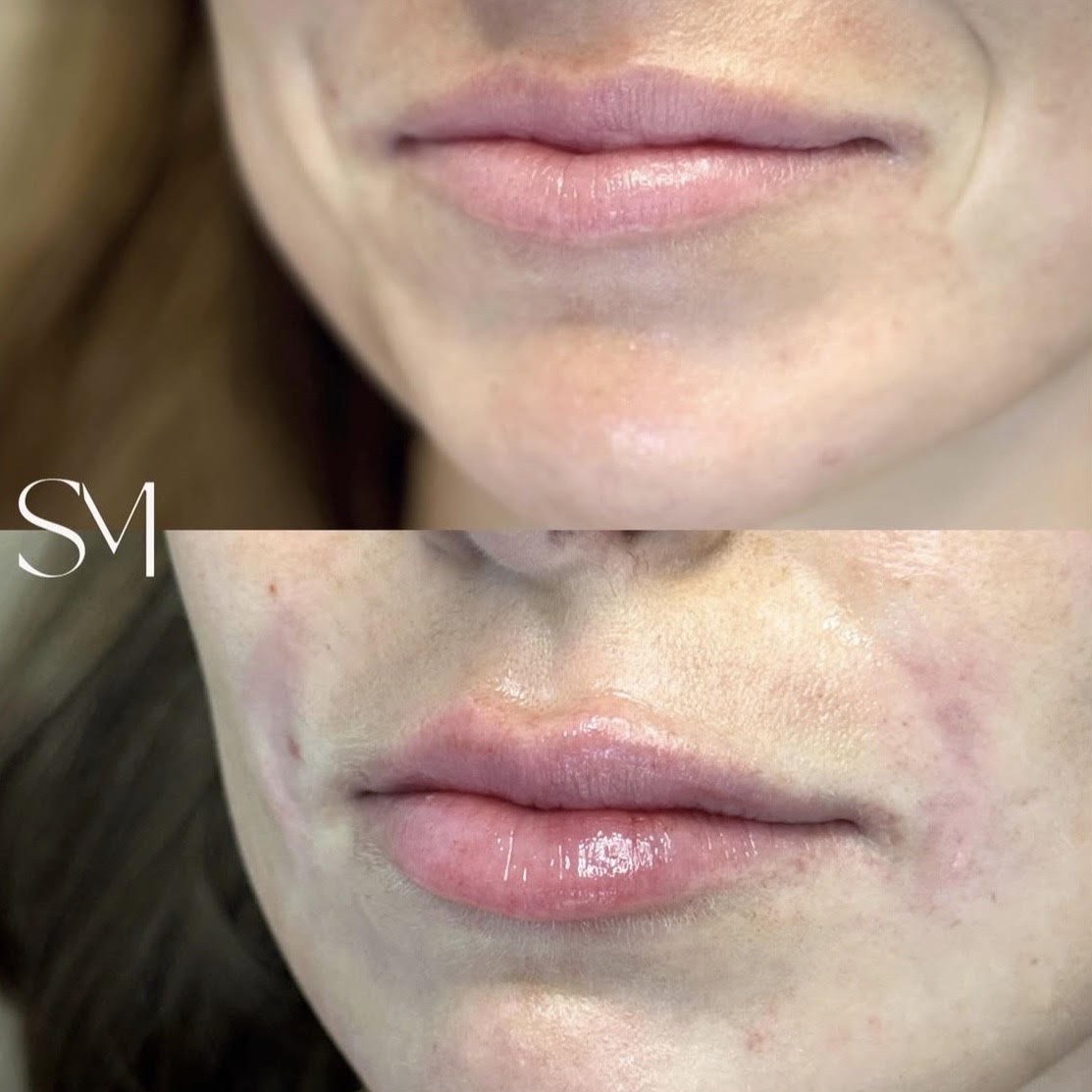 Lip Filler