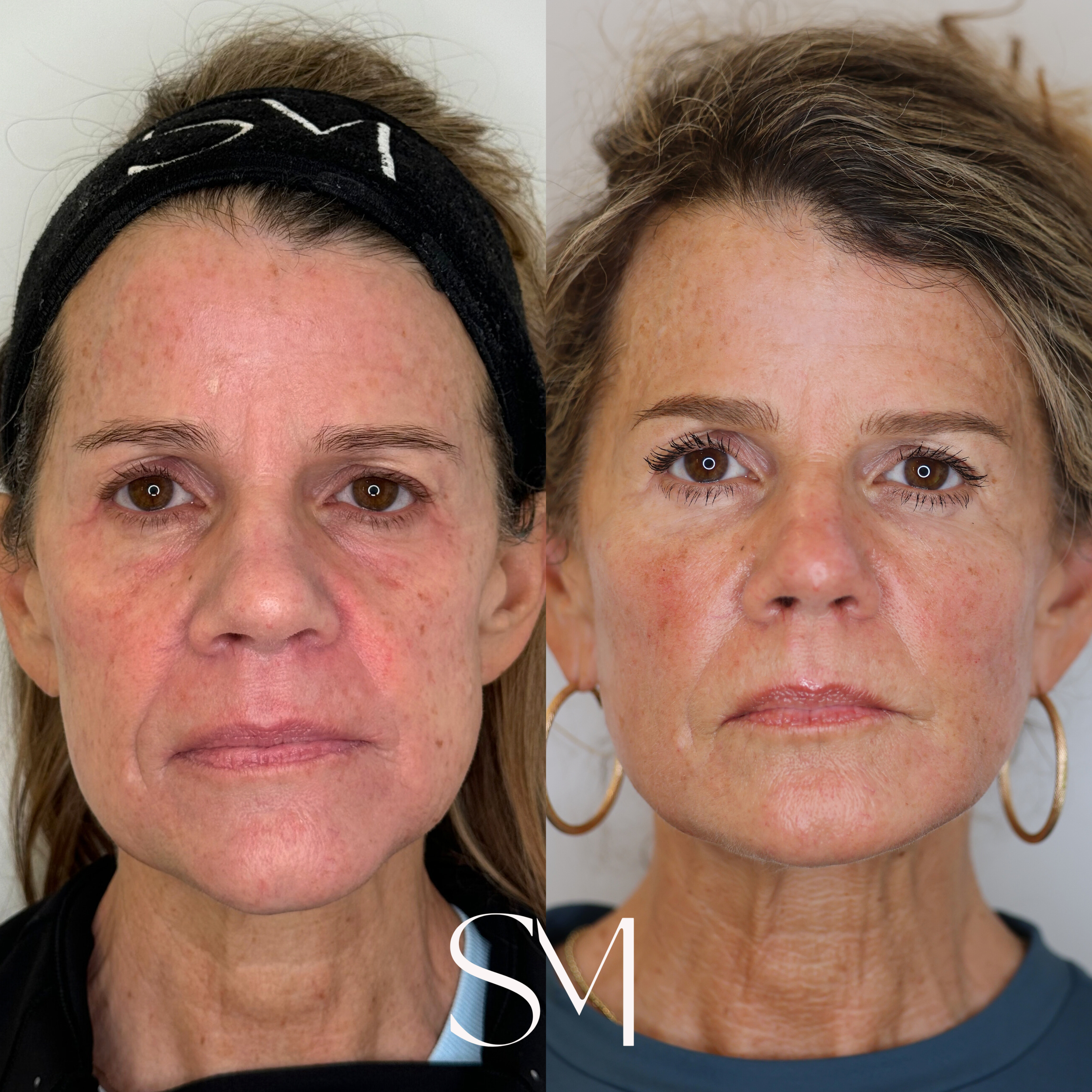 Full Face Derma PRP + NouvaDerm Face + Neck