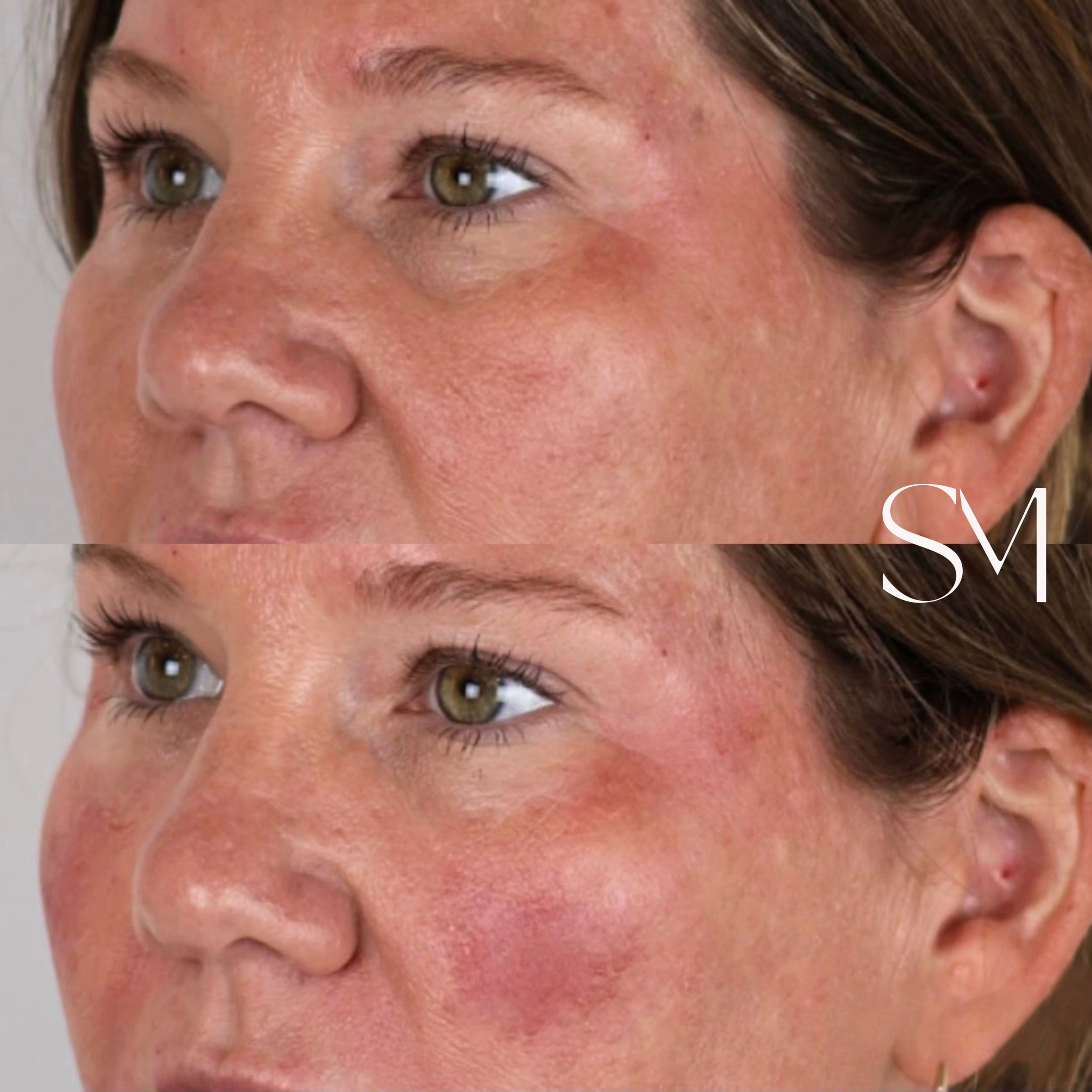 Filler Tear Troughs, Nasolabial Folds, & Cheeks