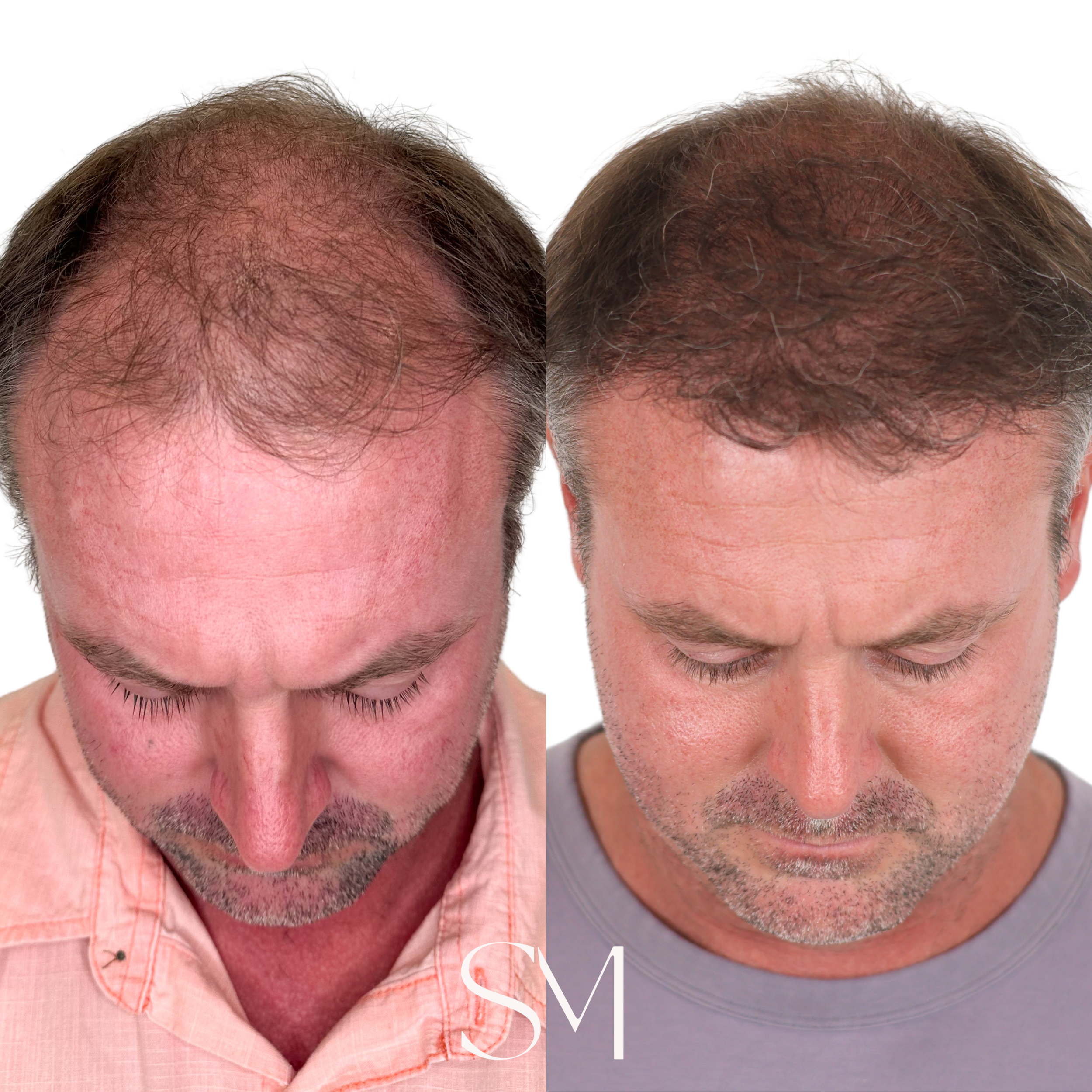 NeoGraft Hair Transplant