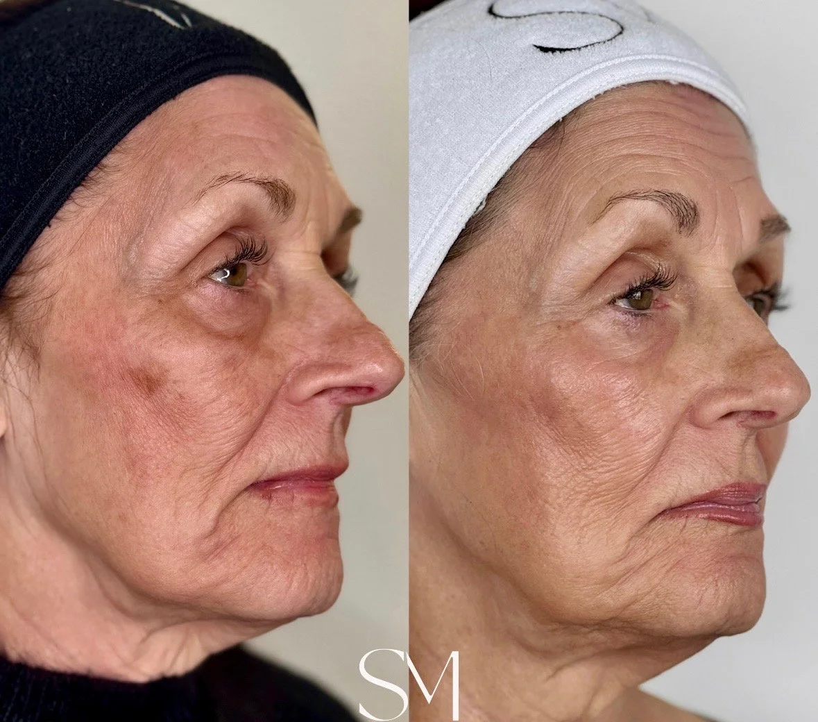 NouvaDerm Face & Neck
