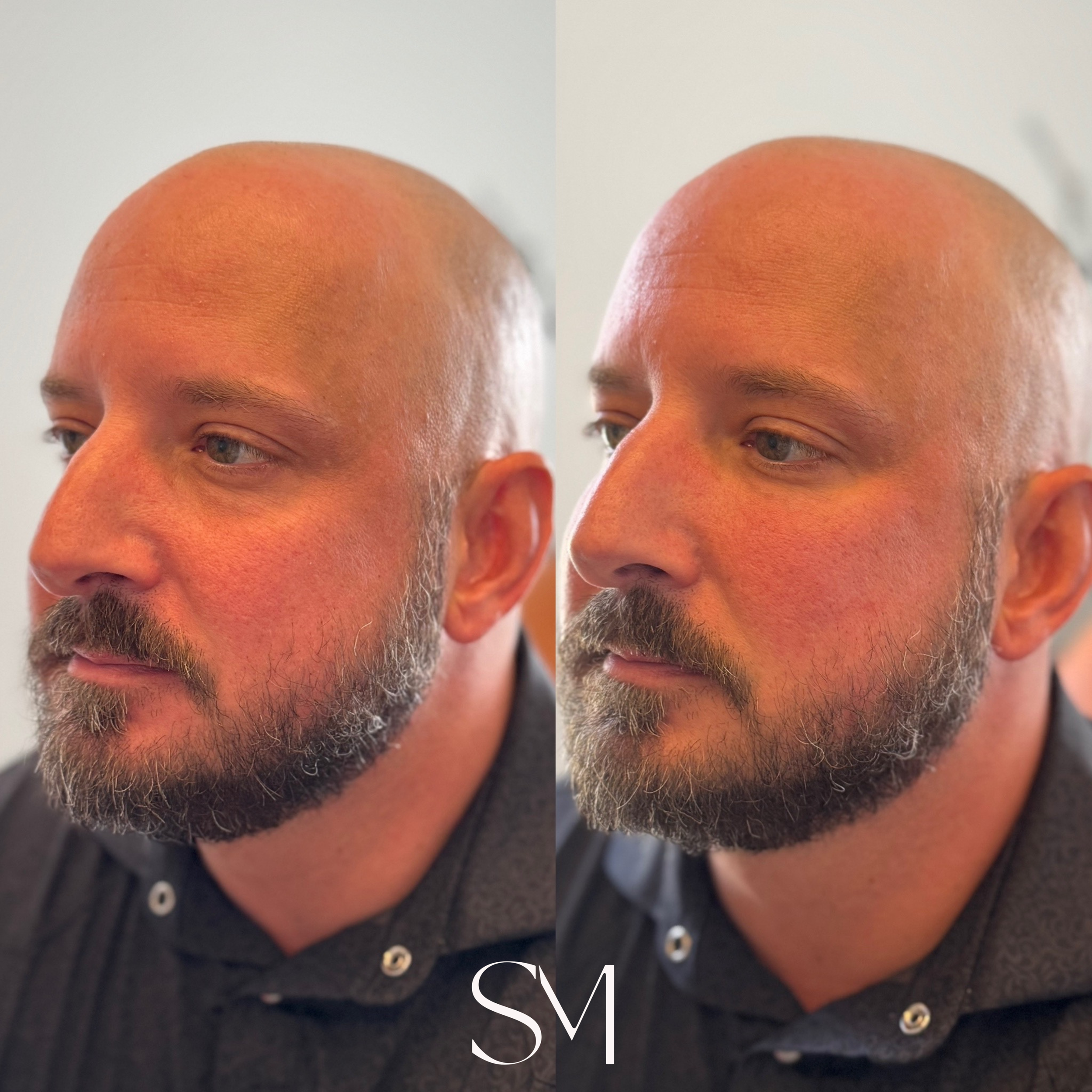 Full Face Derma PRP