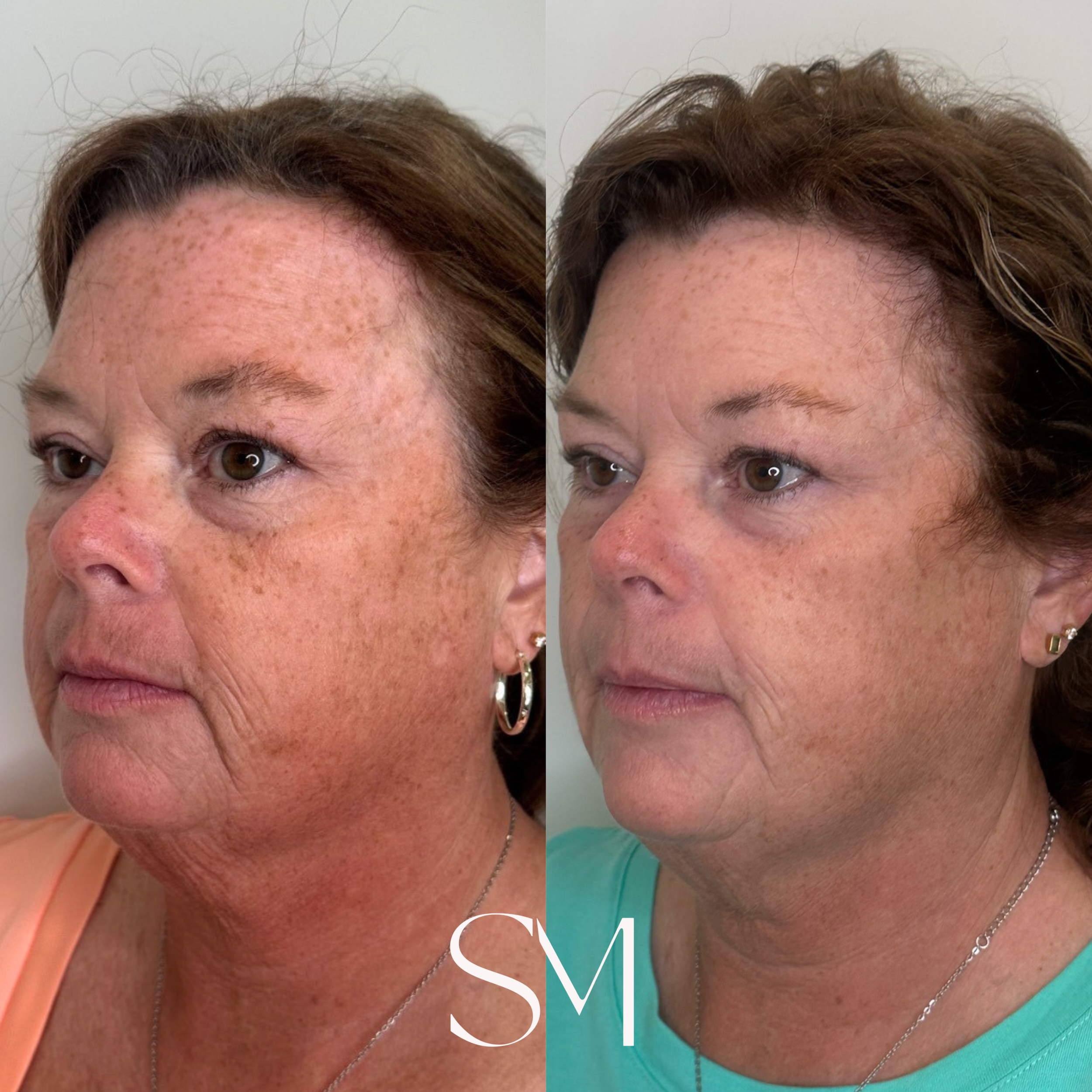One NouvaDerm Treatment
