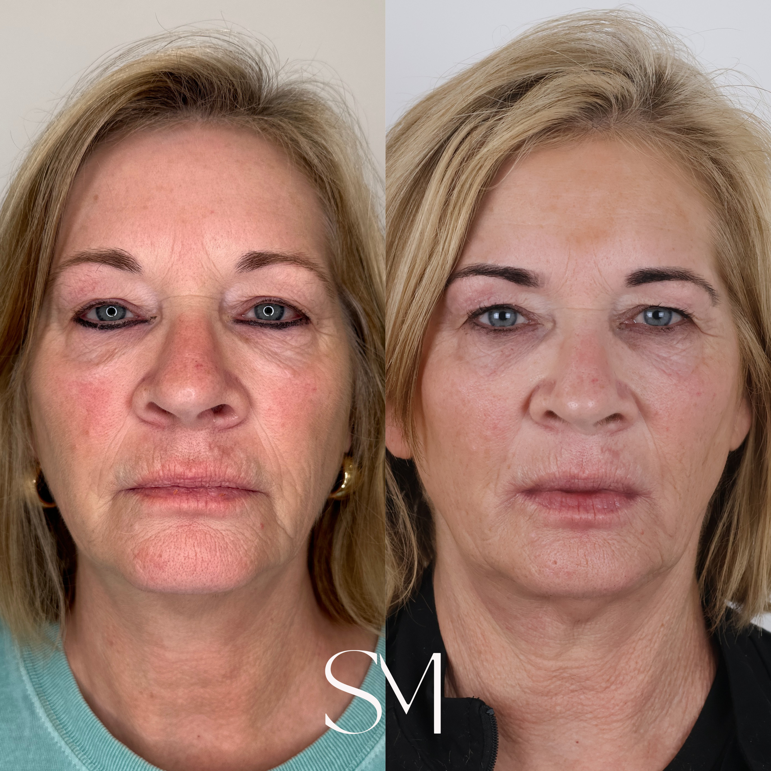 Scarlet RF + NouvaDerm