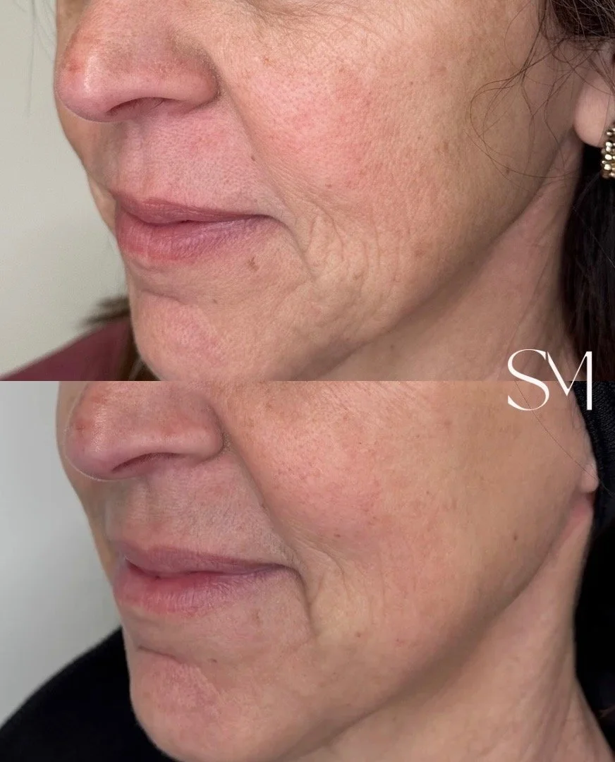 Two NouvaDerm Treatments