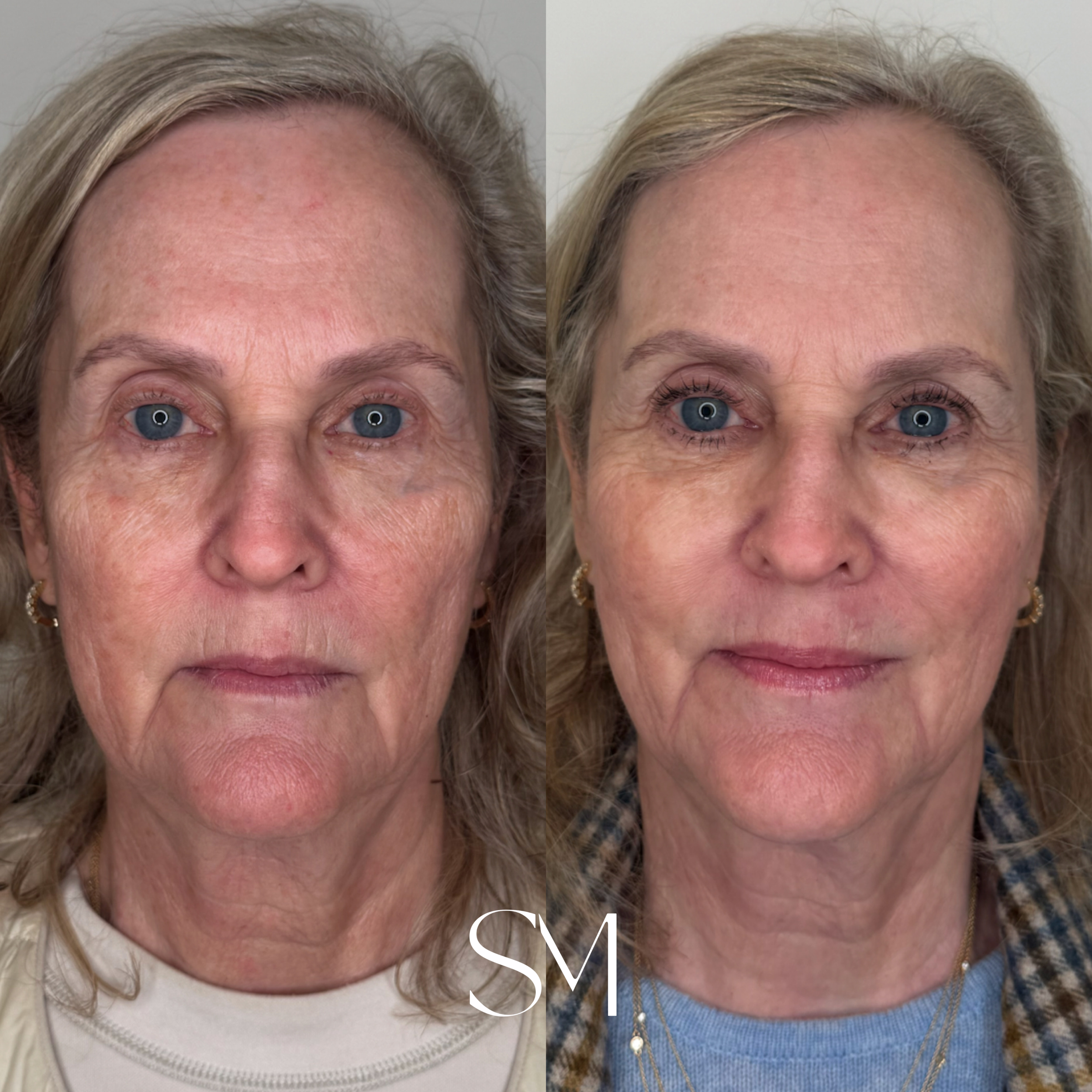 One NouvaDerm Treatment + ZO Peptide *6 Weeks*