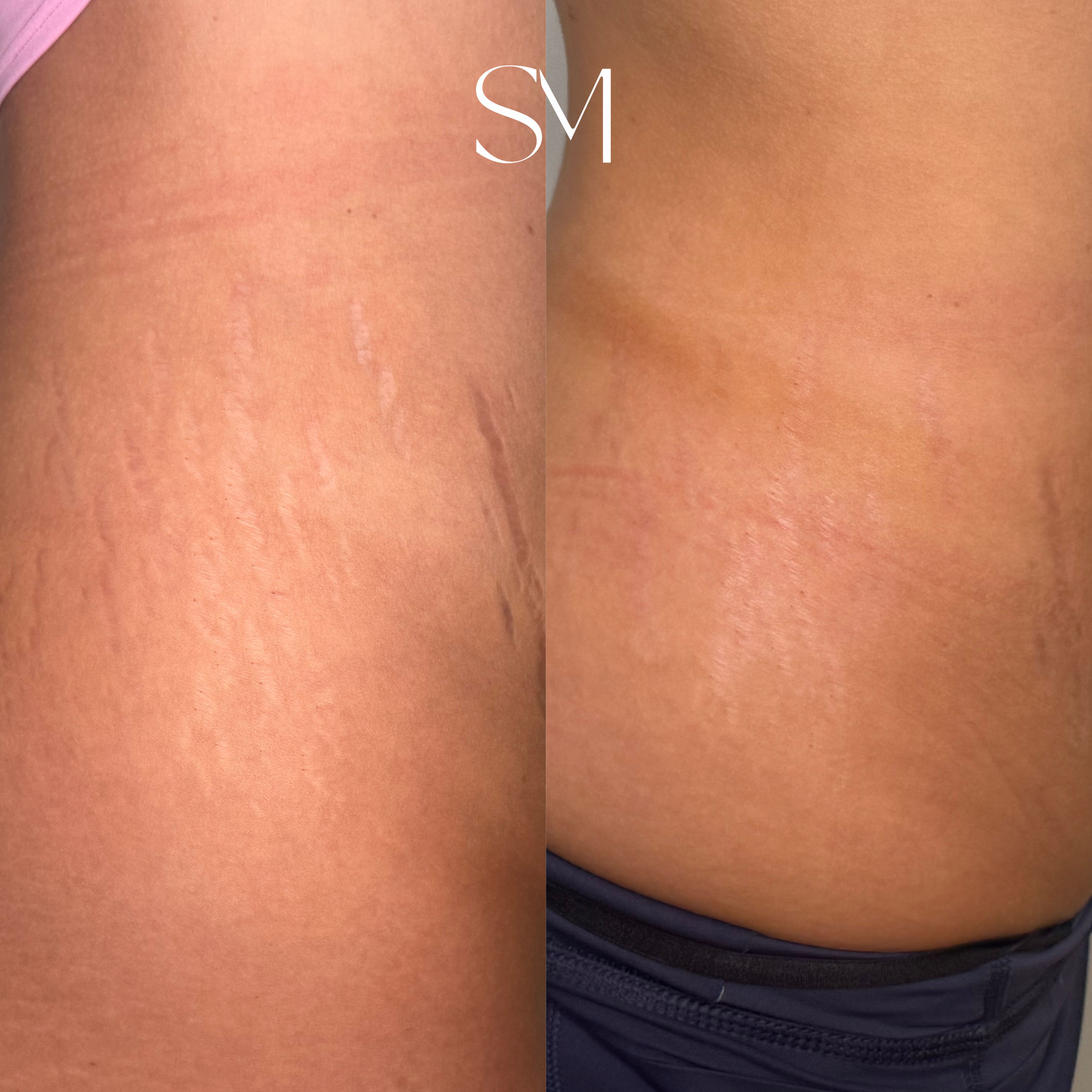 One NouvaDerm Treatment