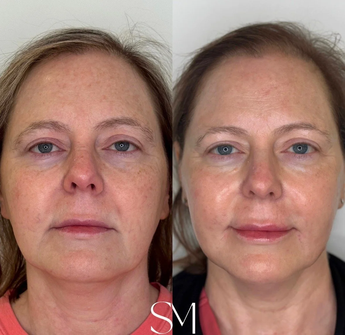 Skin Transformation Membership + NouvaDerm Face & Neck