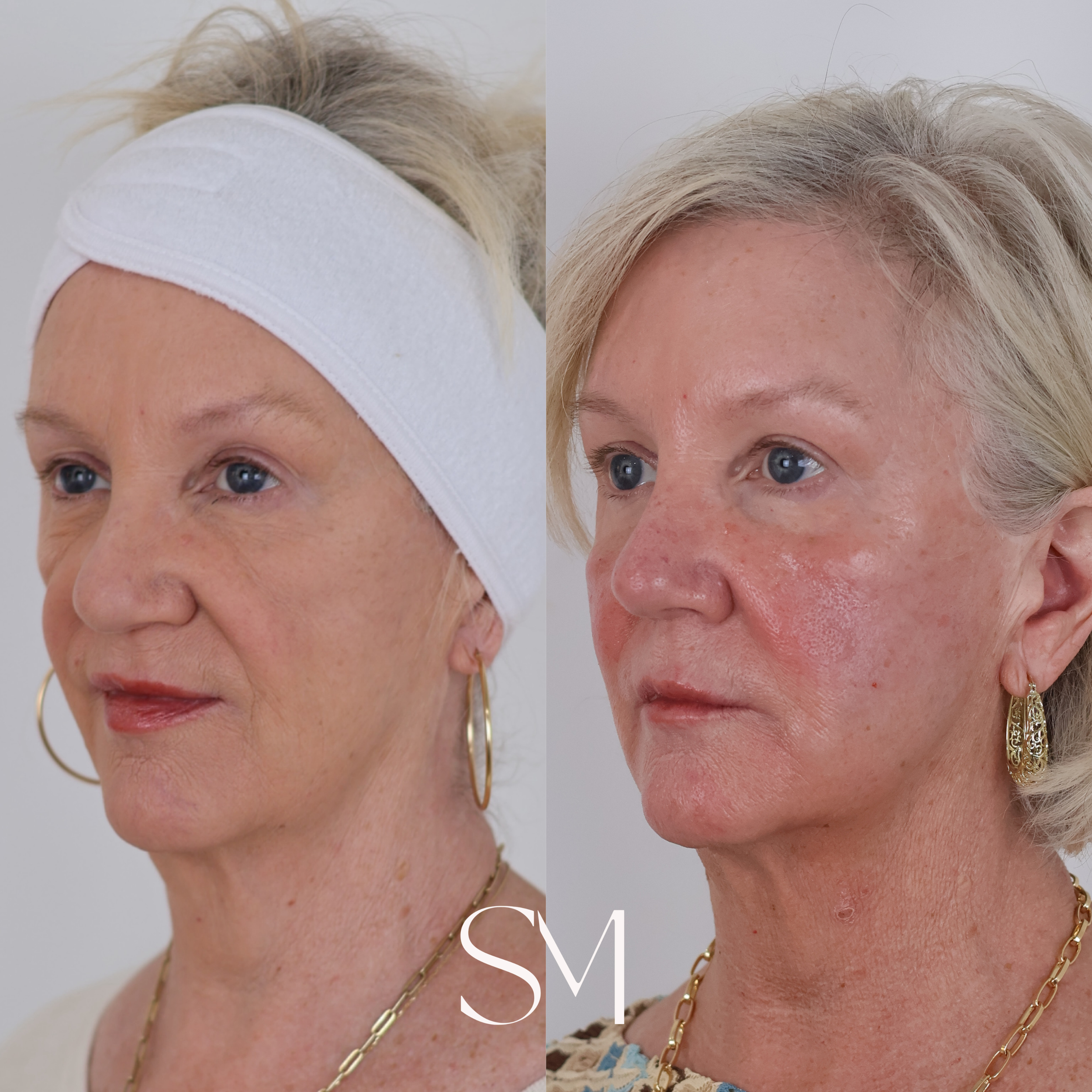 Filler + Sculptra