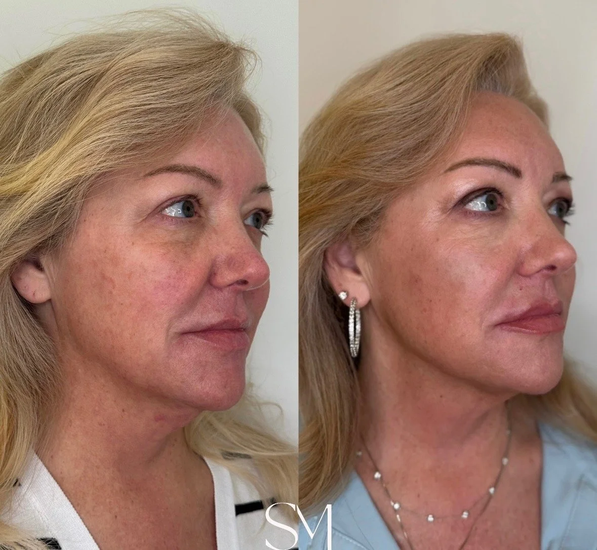 Scarlet RF Face & Neck + Sculptra