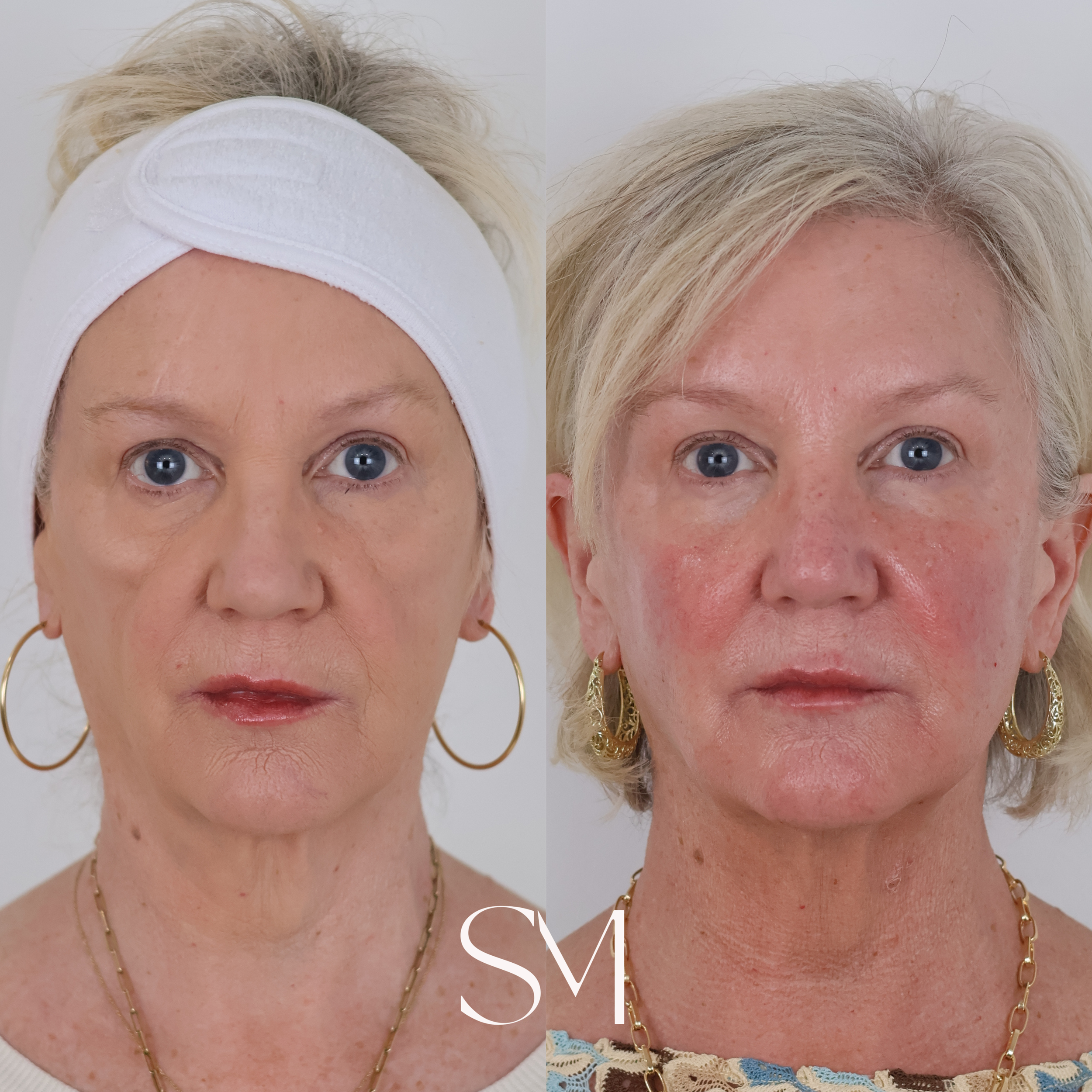 Filler + Sculptra