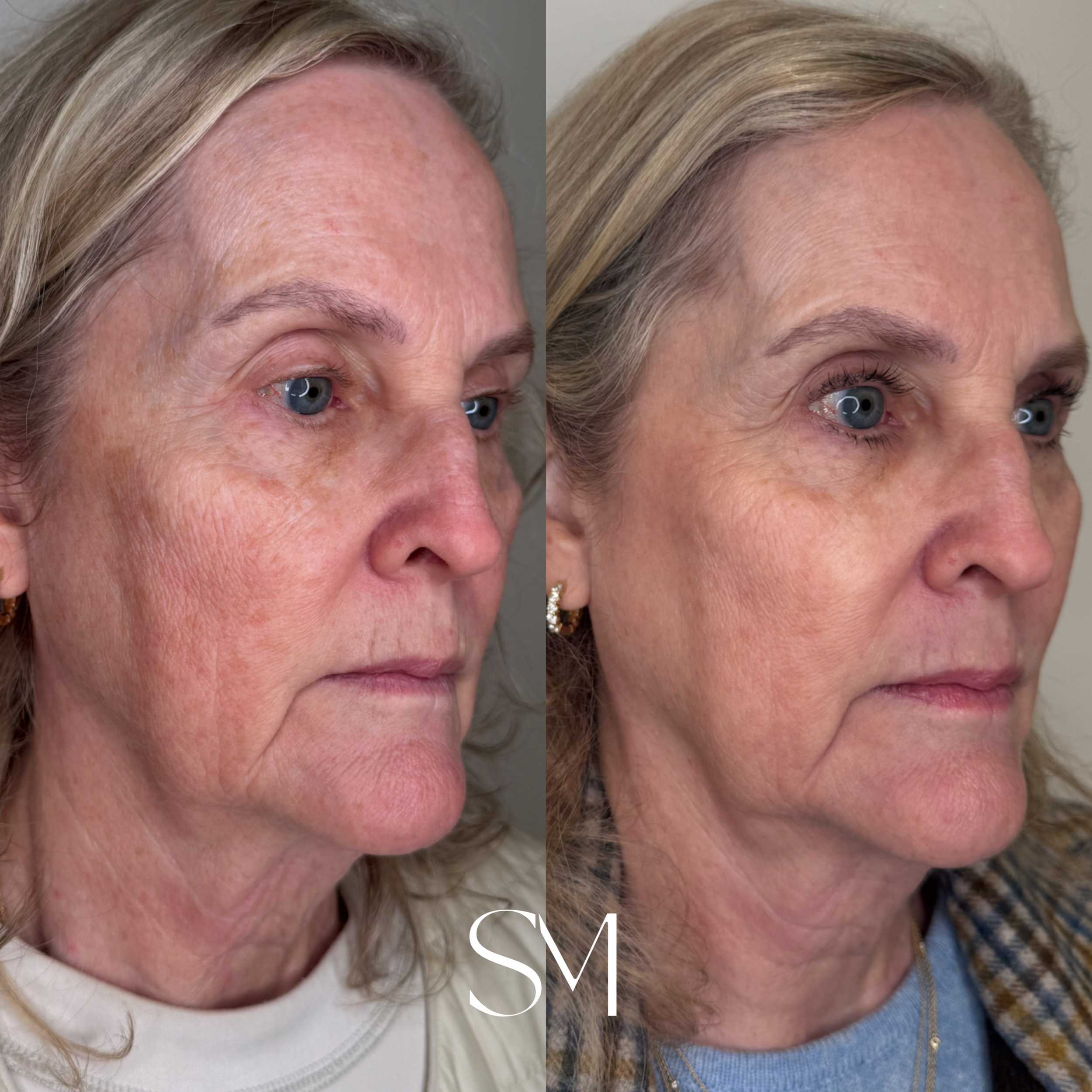 One NouvaDerm Treatment + ZO Peptide *6 Weeks*