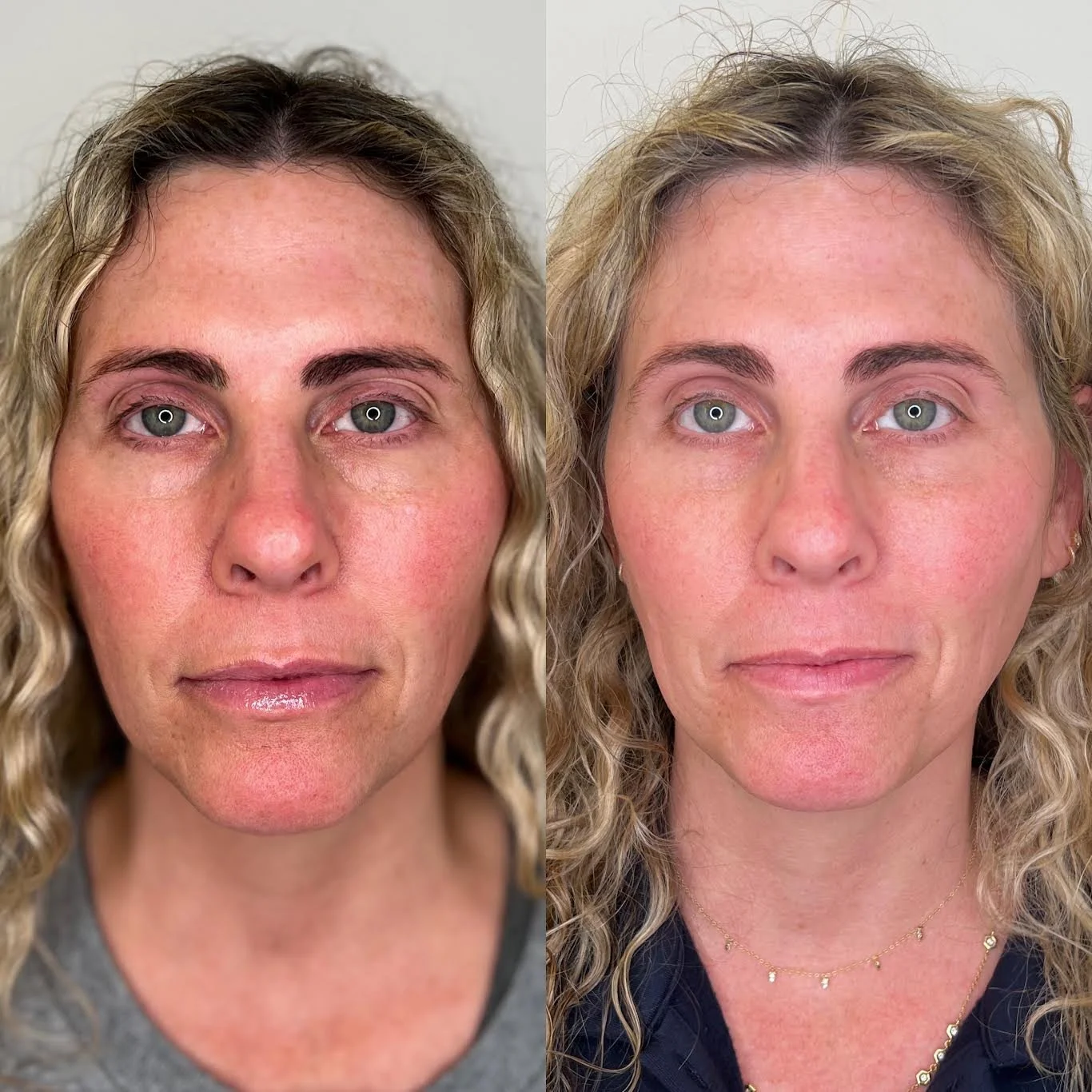 One SkinPen + PRP