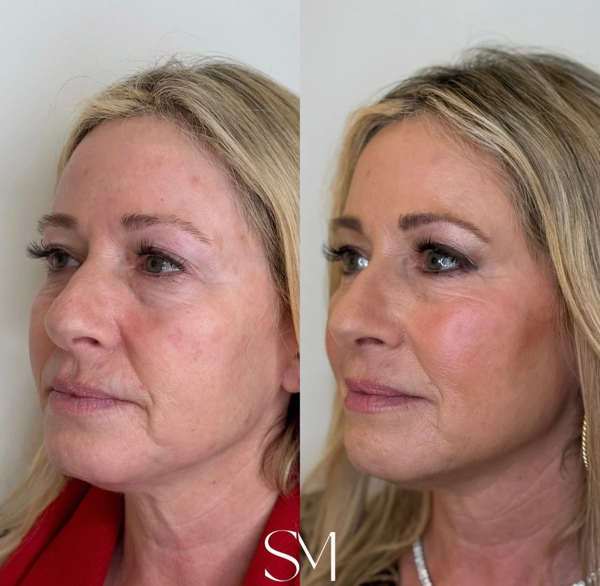 Skin Transformation Membership